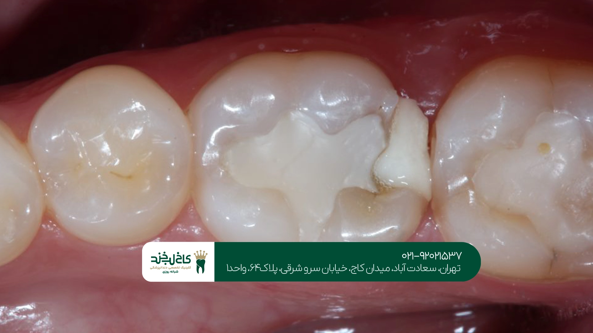 قیمت آمالگام برای پر کردن دندان