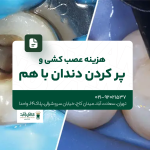 هزینه عصب کشی و پر کردن دندان با هم