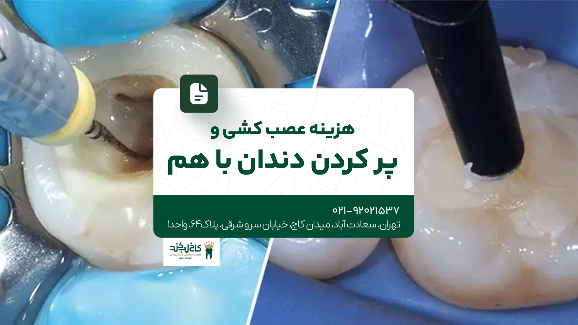 هزینه عصب کشی و پر کردن دندان با هم