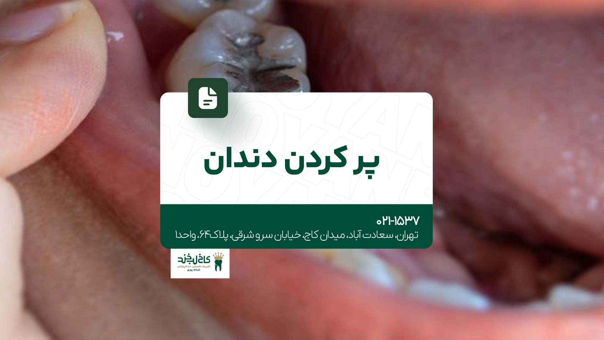 پر کردن دندان