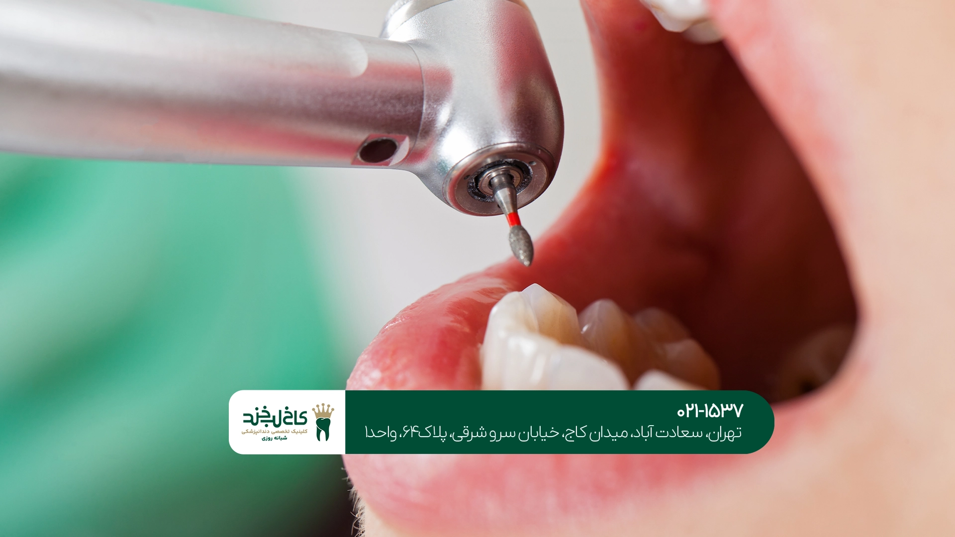 پر کردن دندان