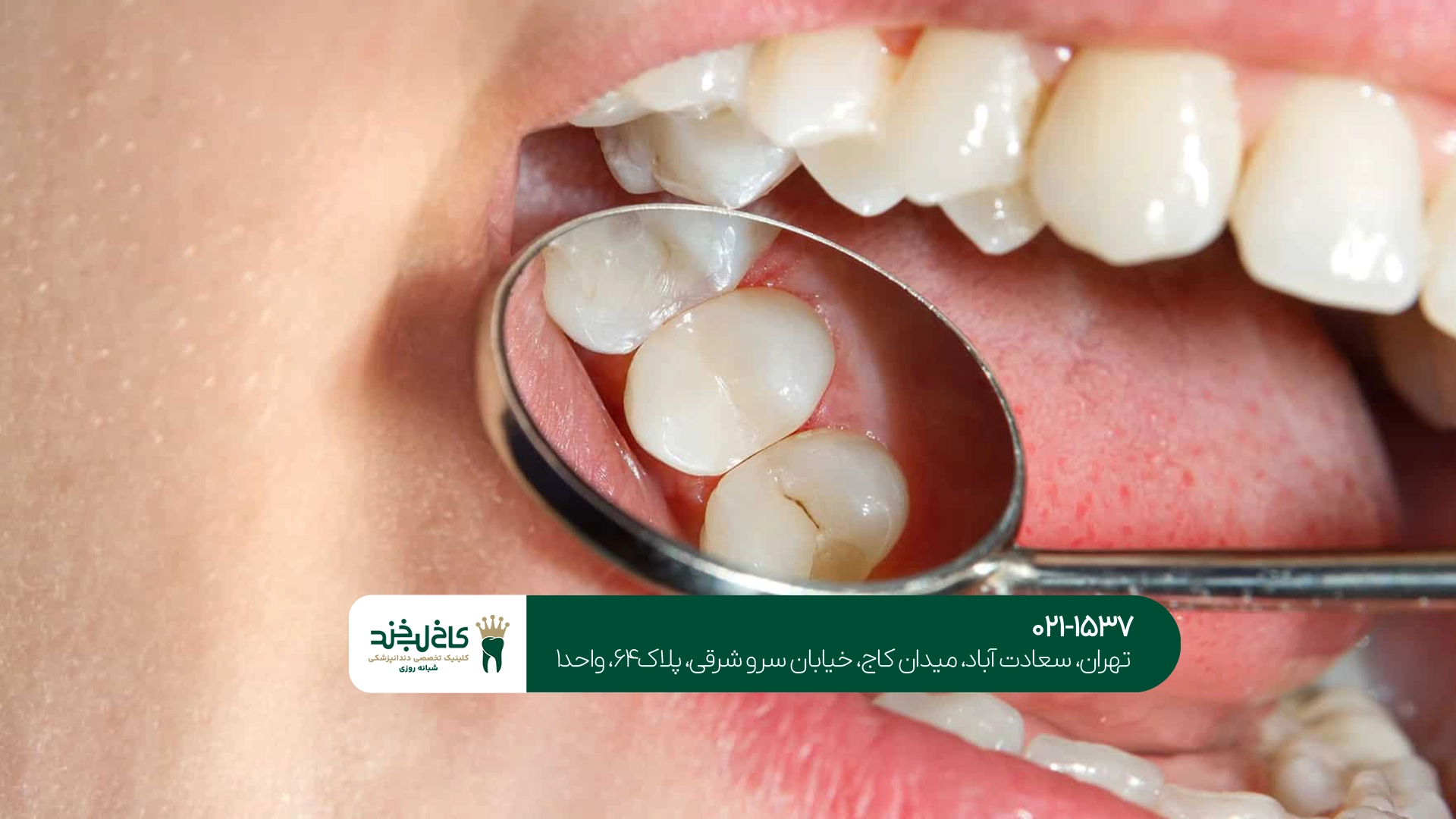 پر کردن دندان