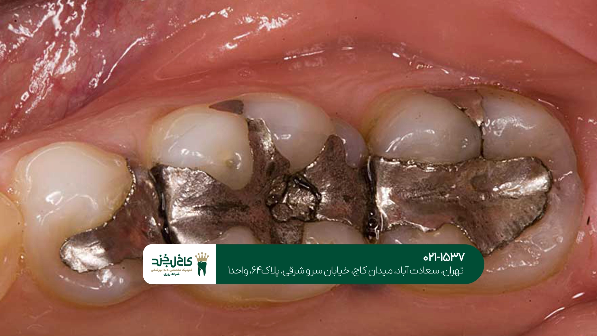 پر کردن دندان