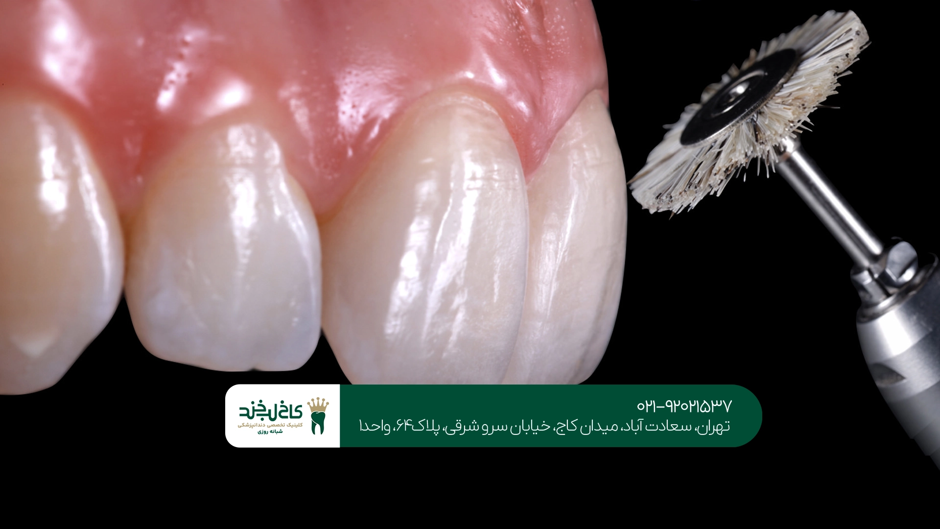کامپوزیت دندان کامپوزیت دندان