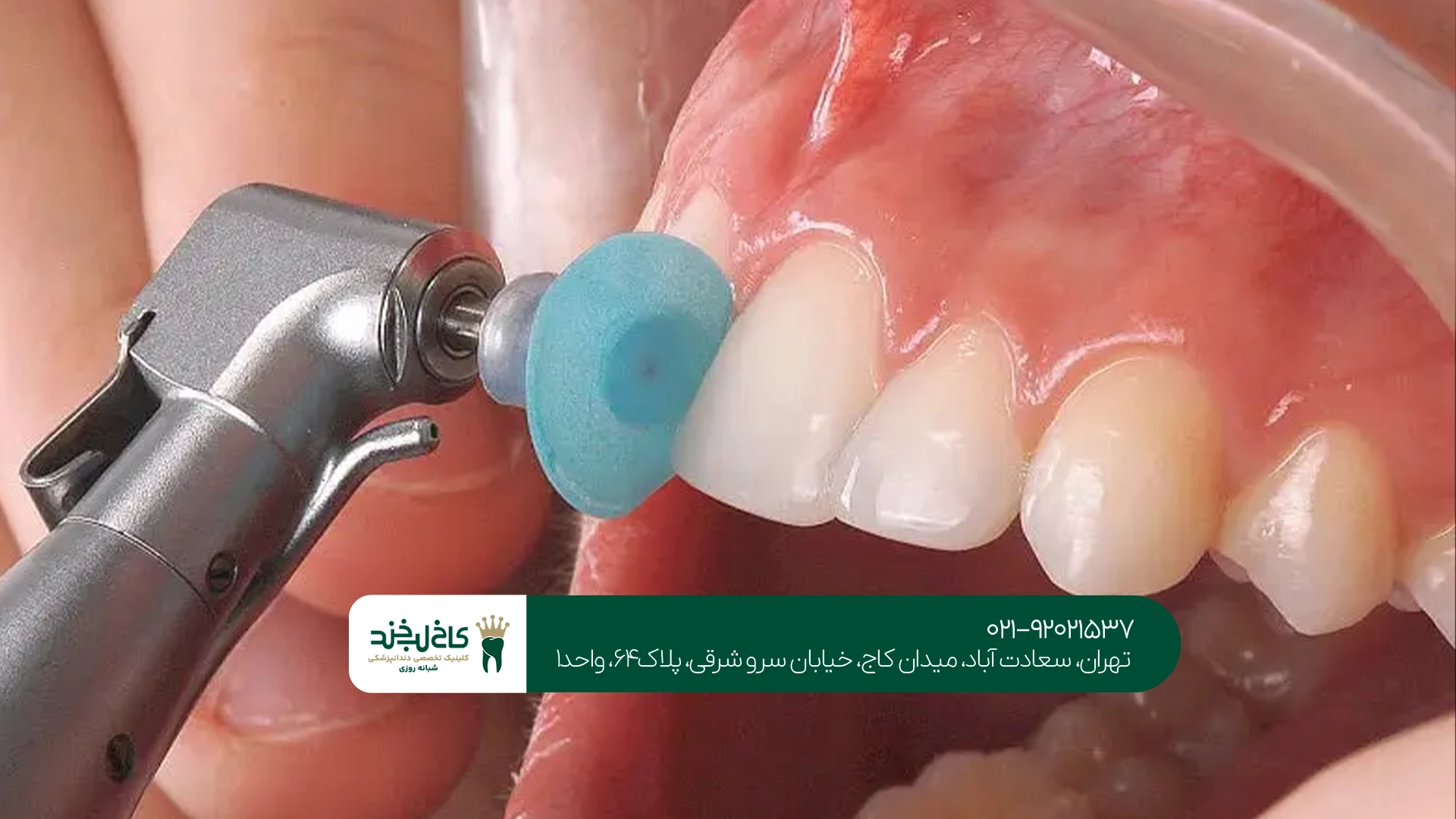 کامپوزیت لیرینگ کامپوزیت لیرینگ