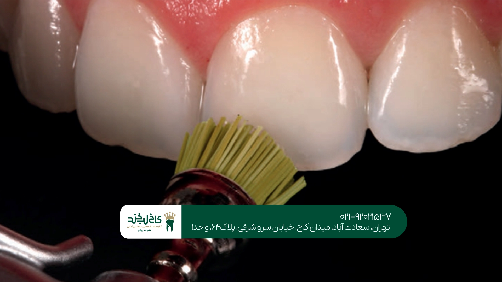 کامپوزیت دندان در تهران کامپوزیت دندان در تهران