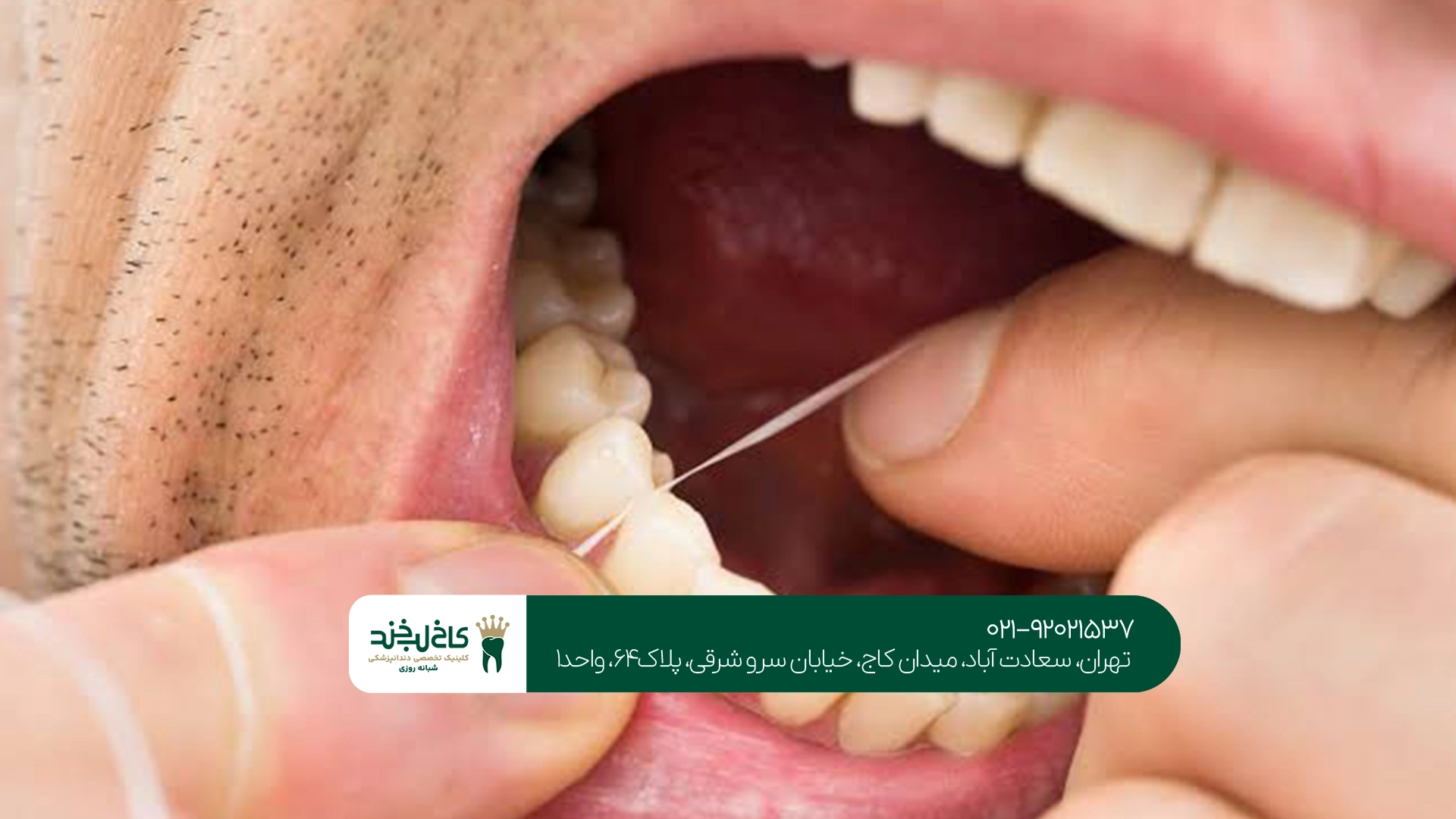 بهترین زمان استفاده از نخ دندان