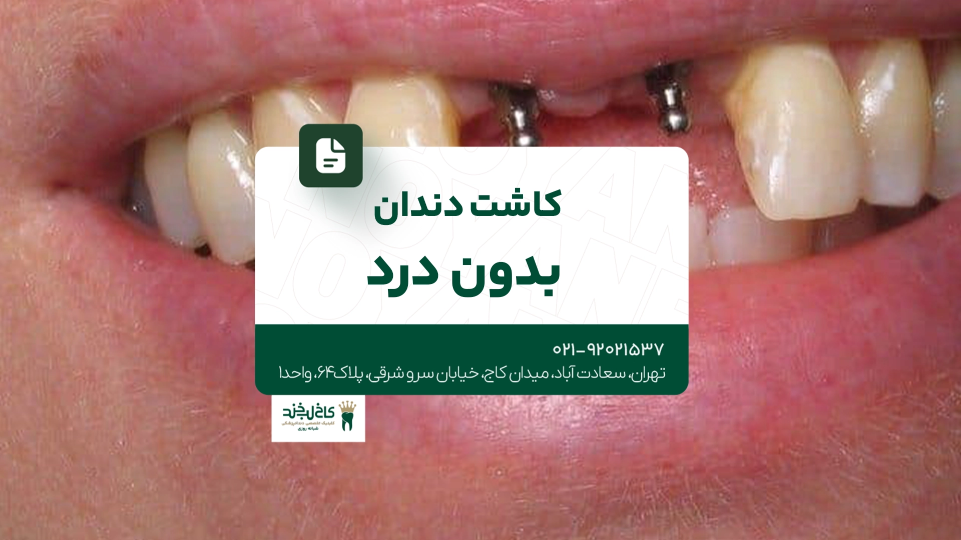 کاشت دندان بدون درد