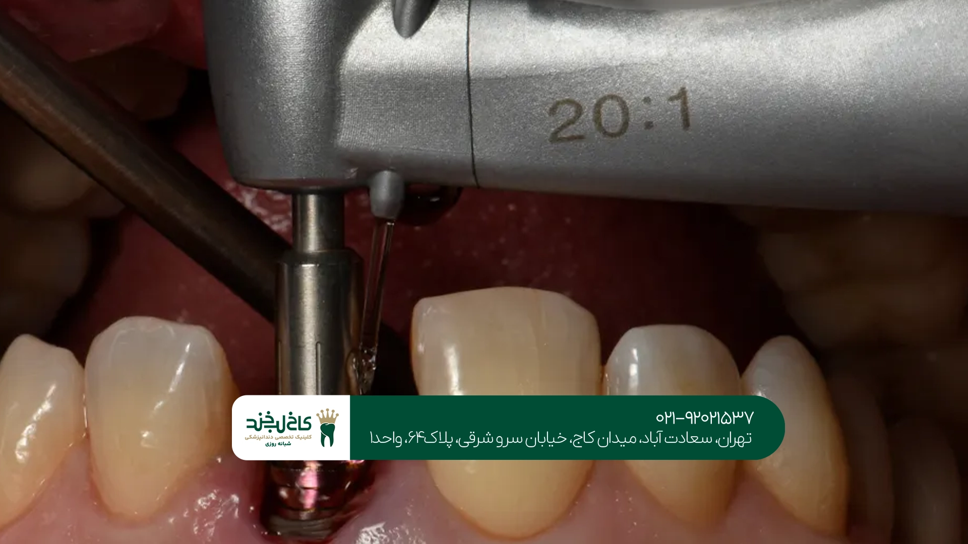 آیا ایمپلنت دندان واقعاً بدون درد است؟
