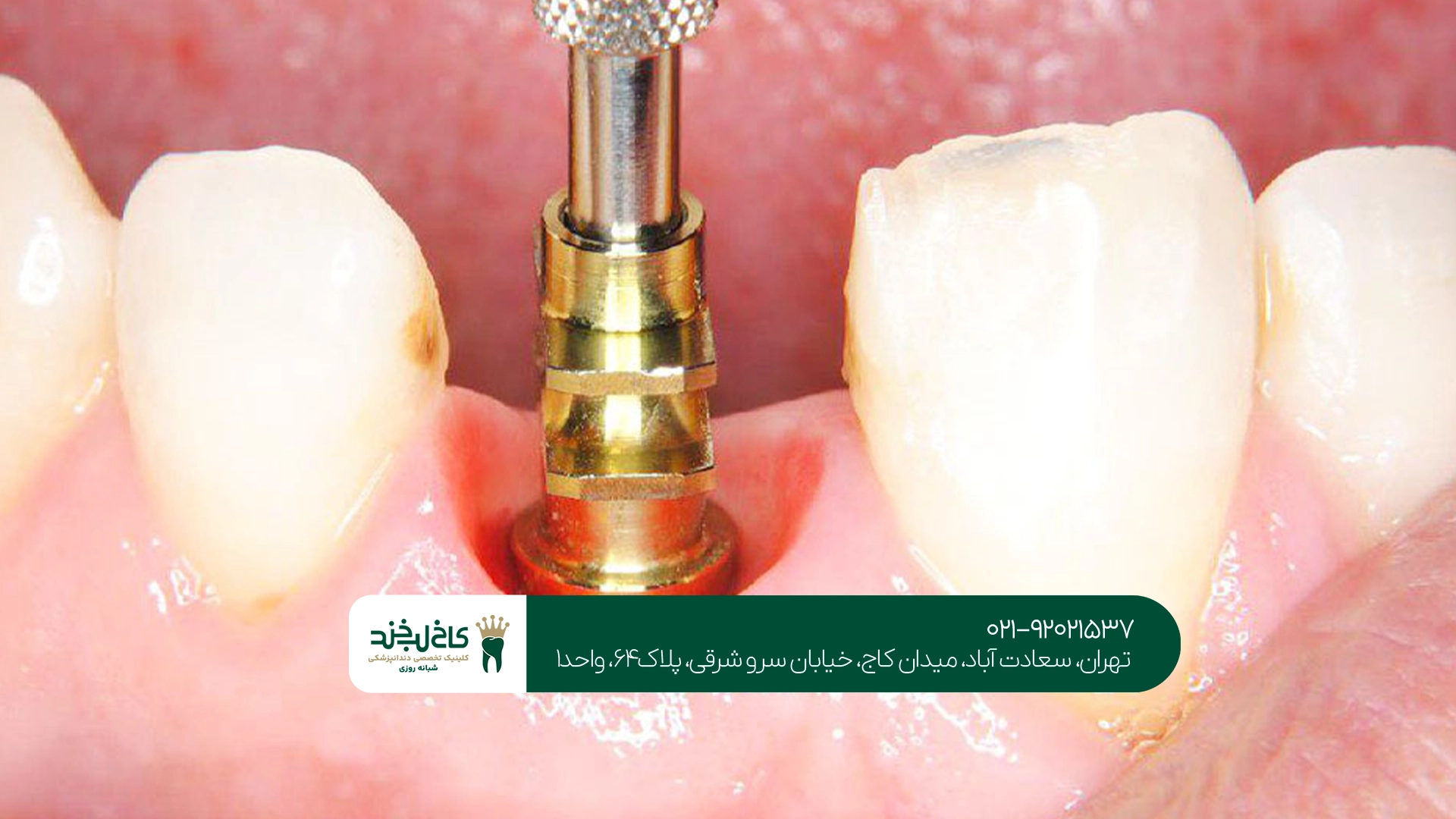 ایمپلنت بدون درد