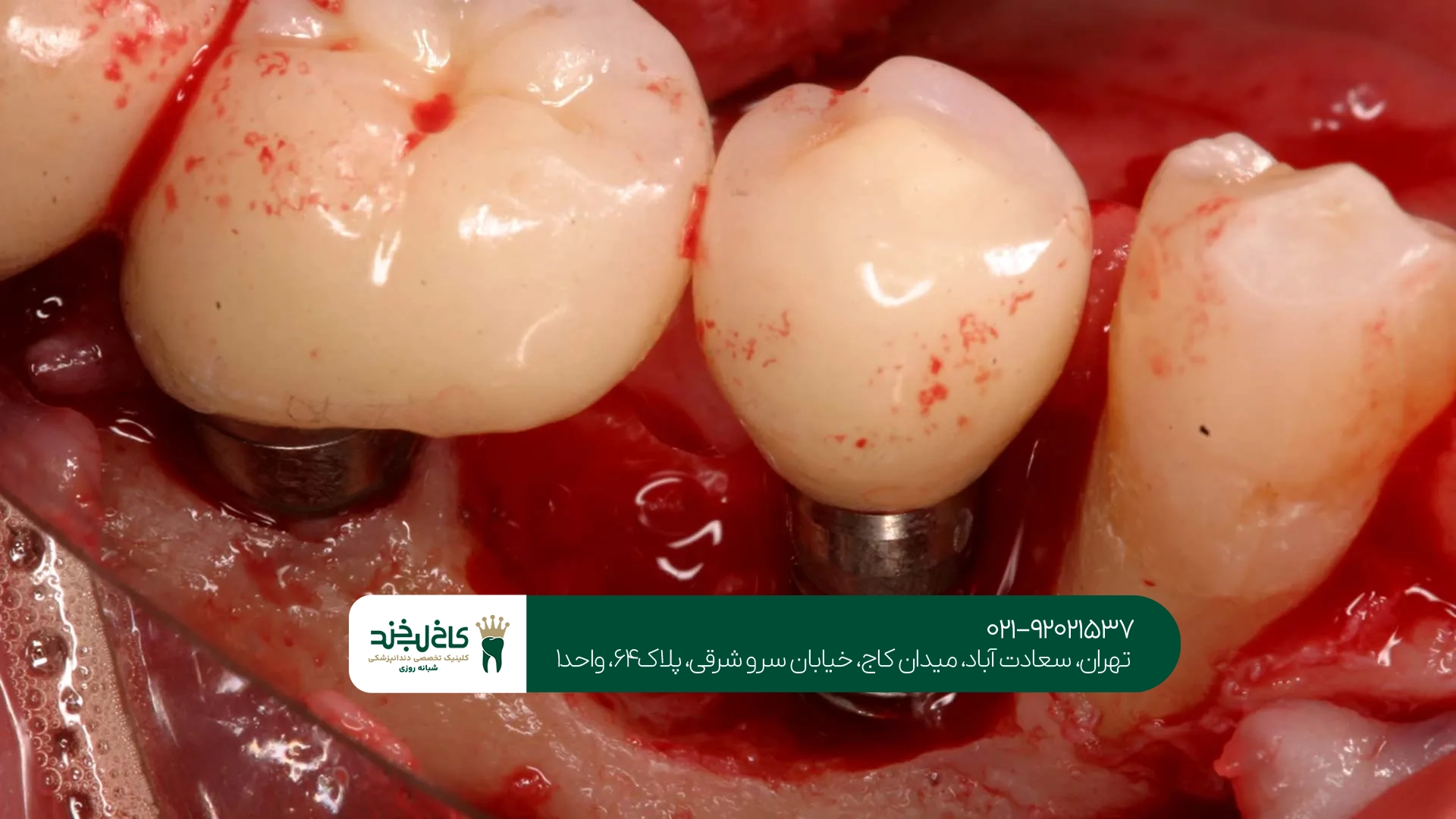 کاشت دندان اقساطی