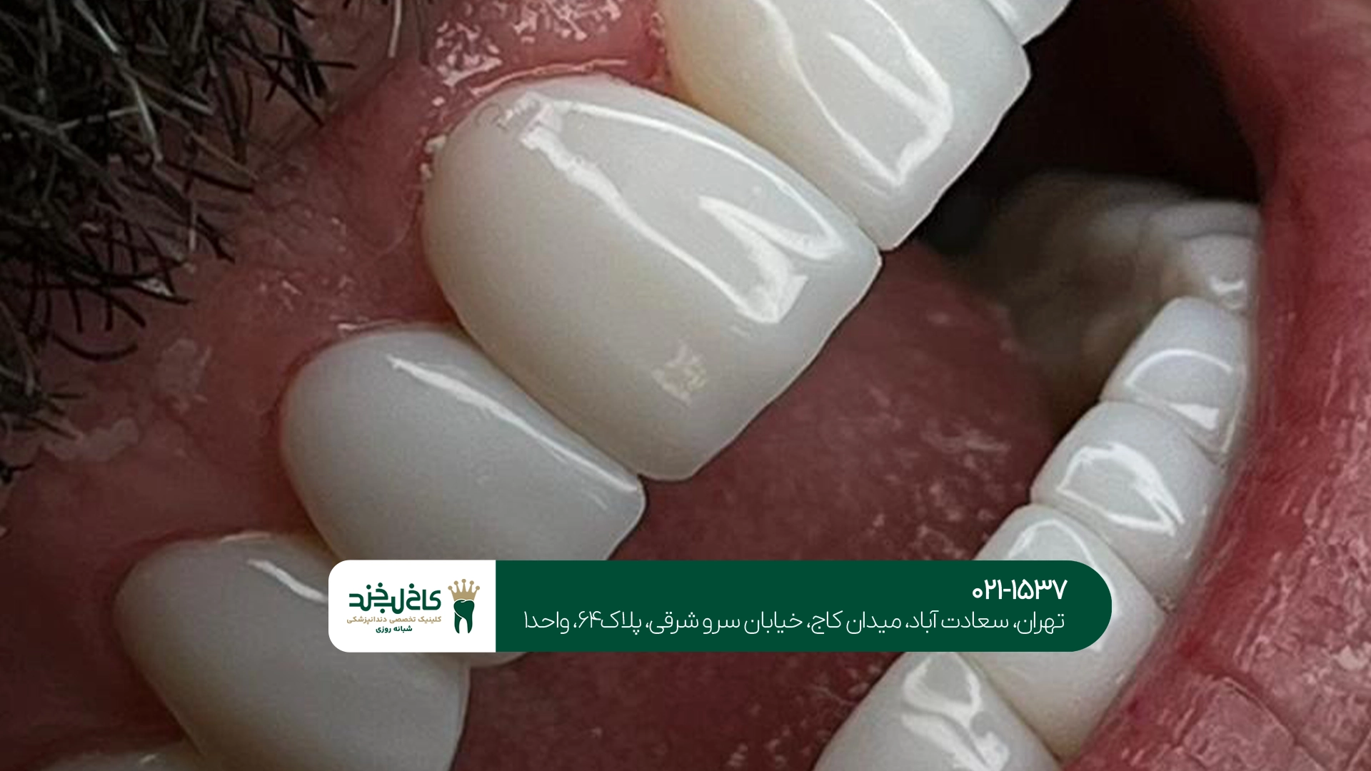 کامپوزیت دندان