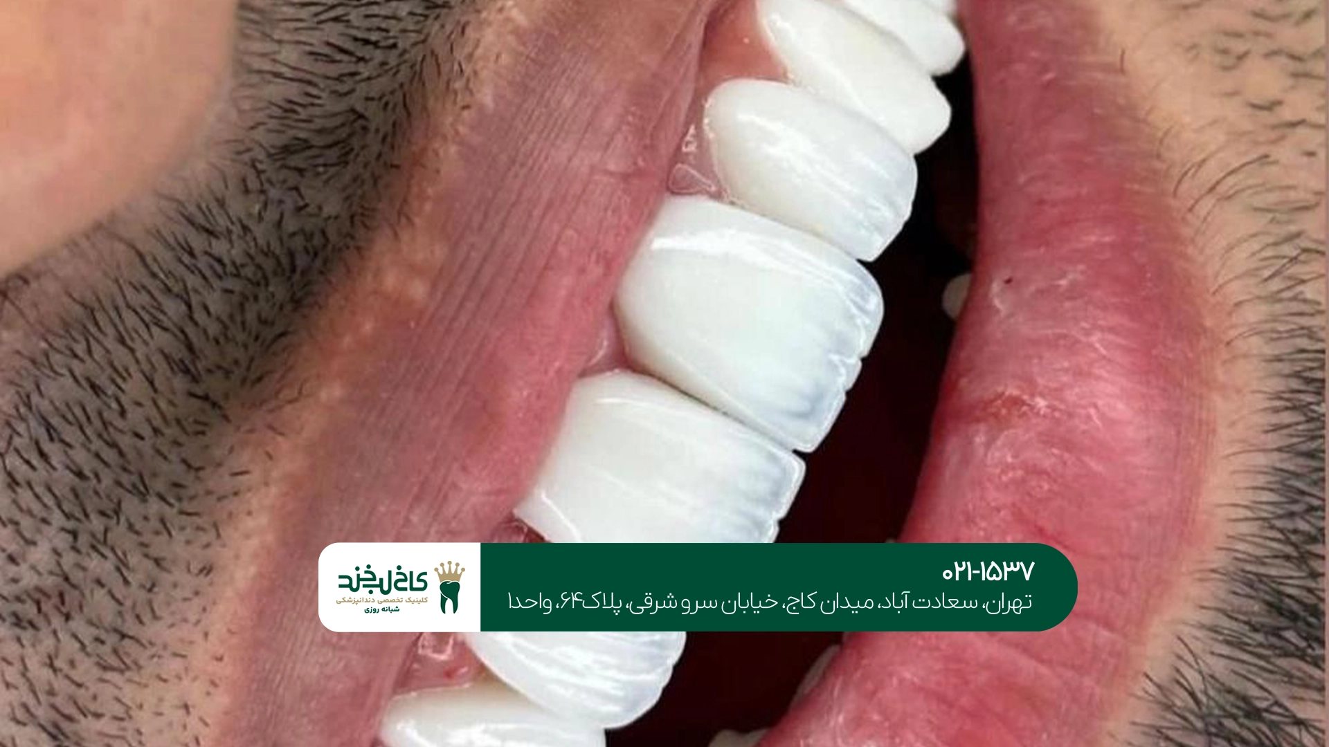 کامپوزیت دندان