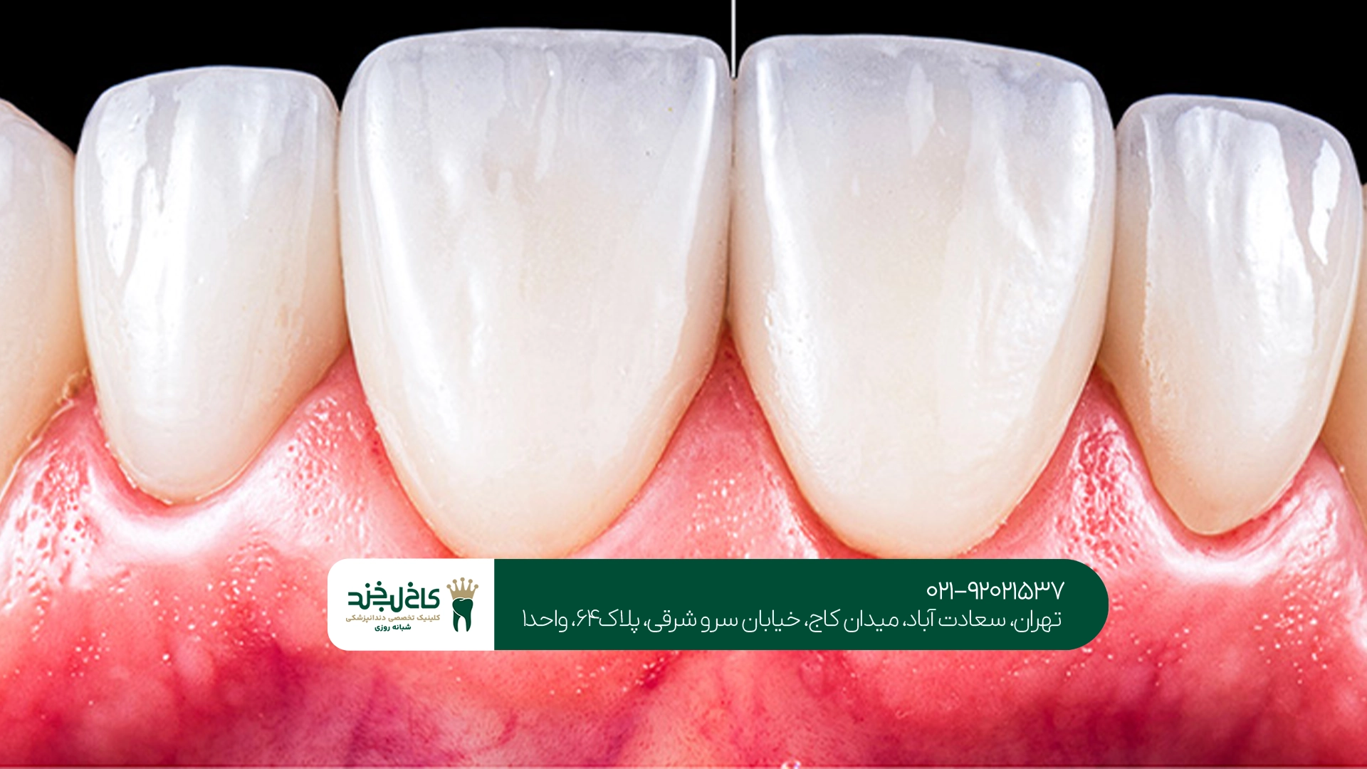 تفاوت کامپوزیت دیجیتال با کامپوزیت معمولی