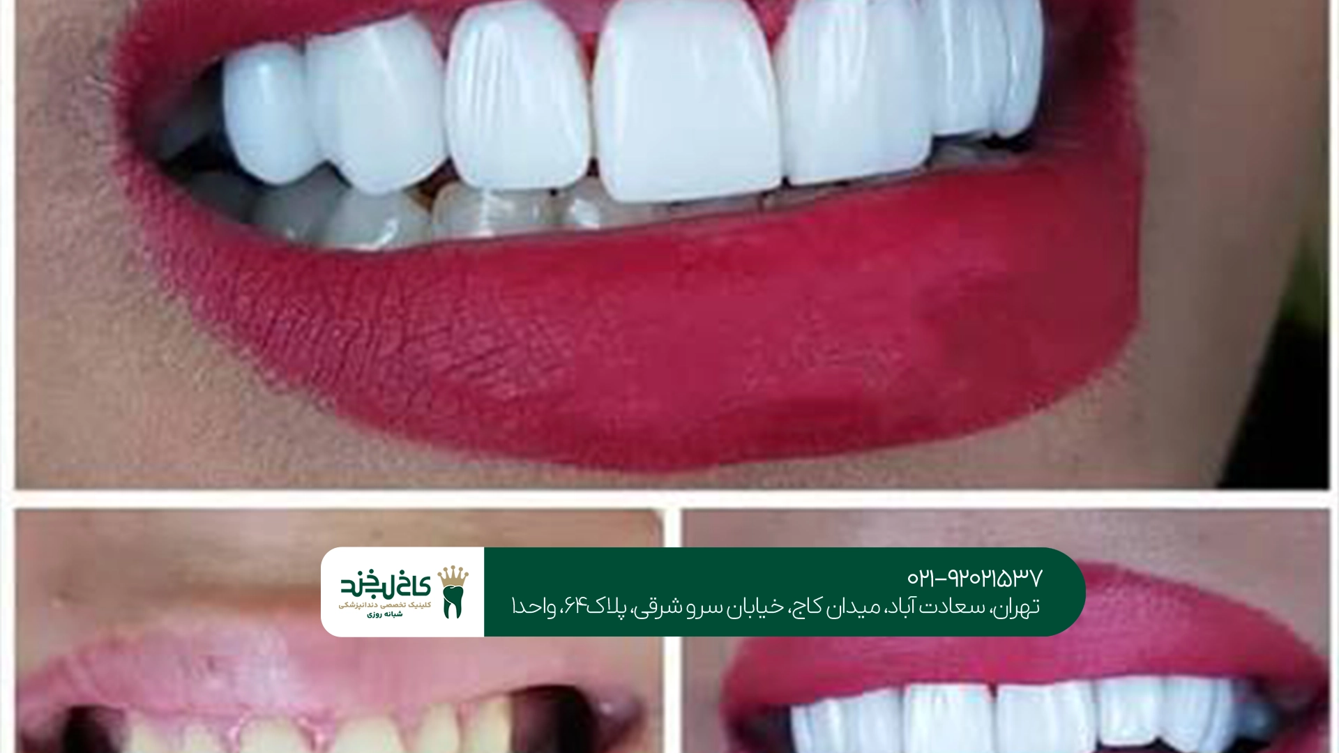 تفاوت کامپوزیت زنیت با سایر برندهای کامپوزیت