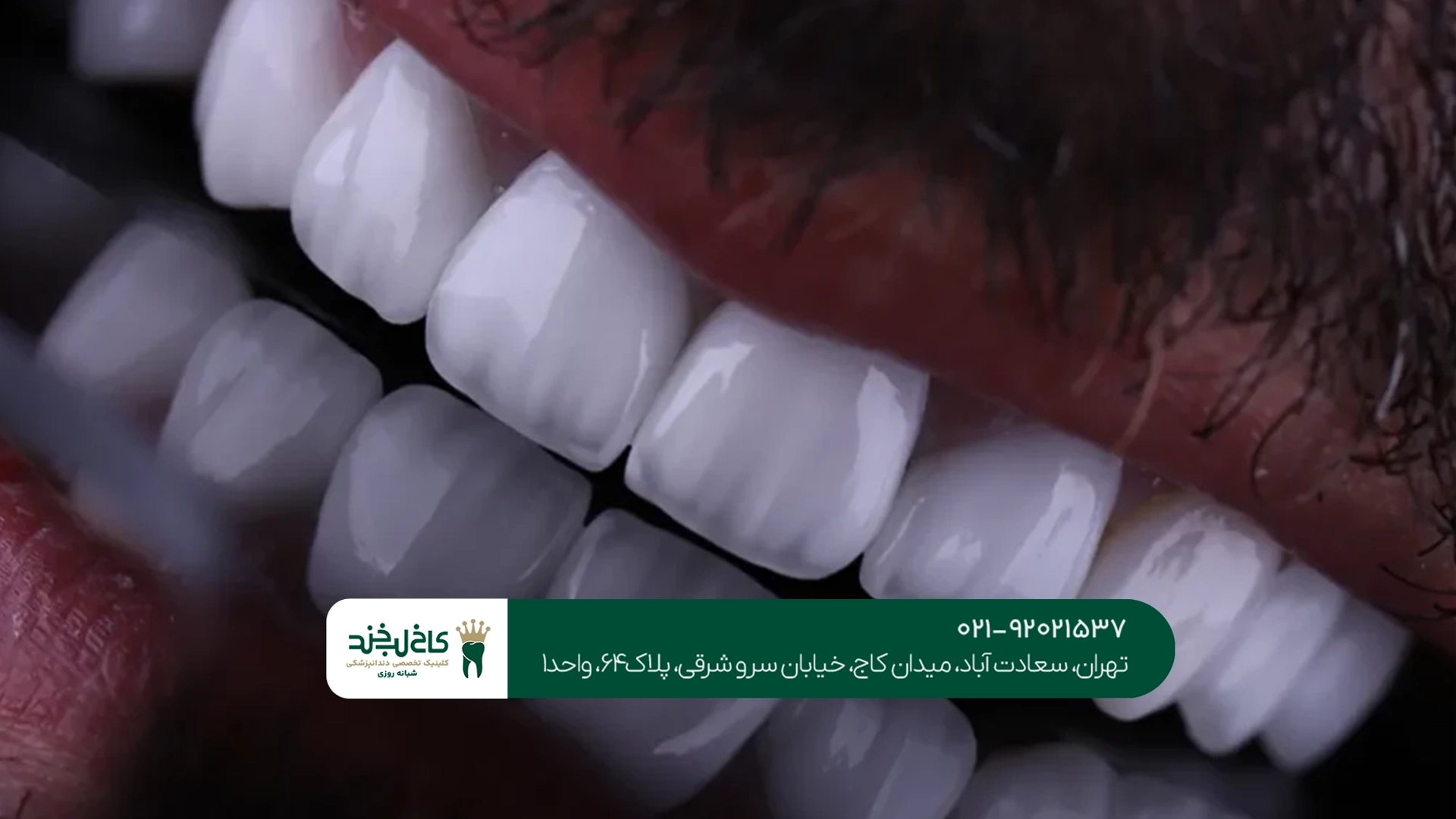 مزایای کامپوزیت لیرینگ