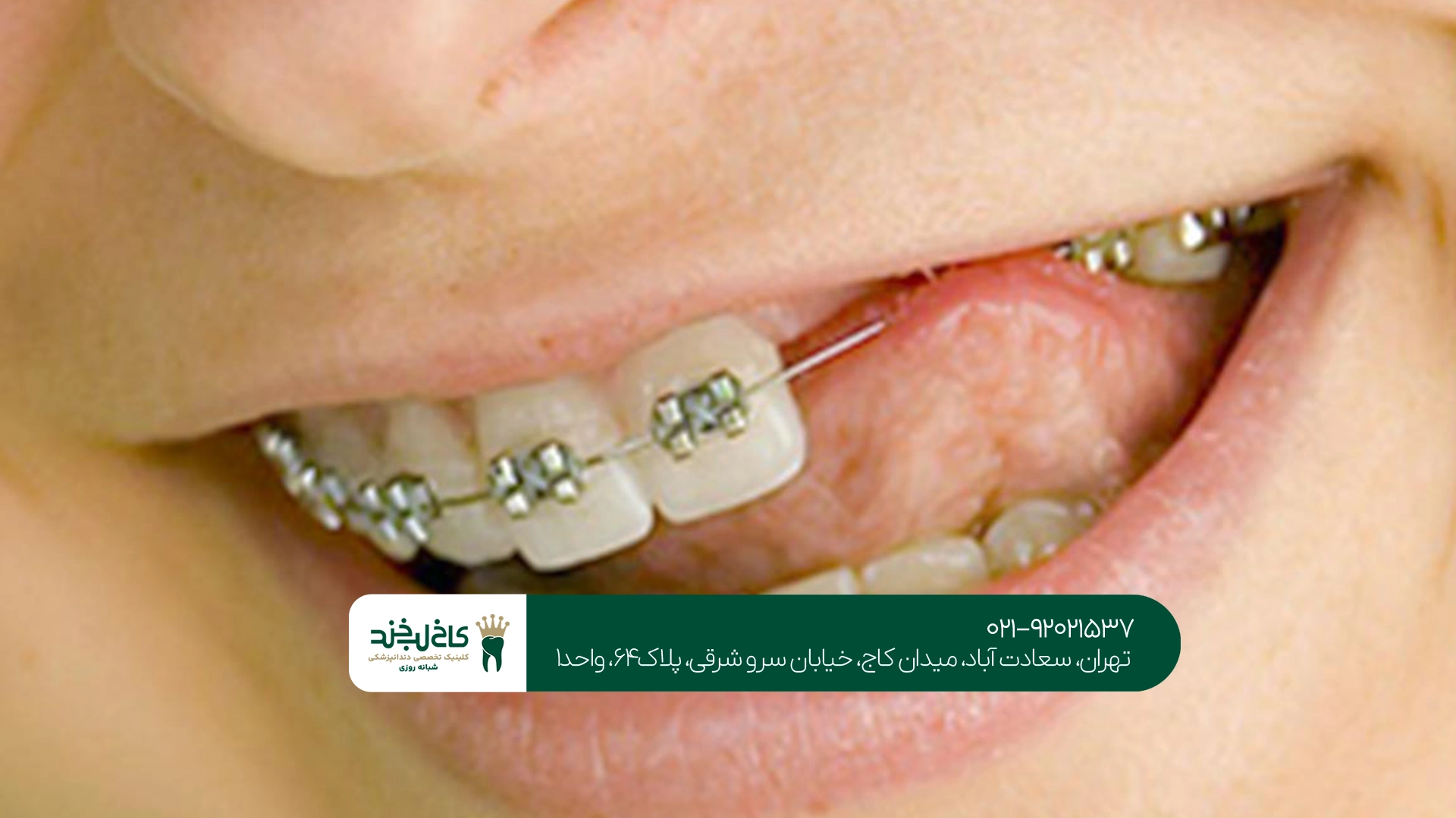 ارتودنسی دندان در تهران ارتودنسی دندان در تهران