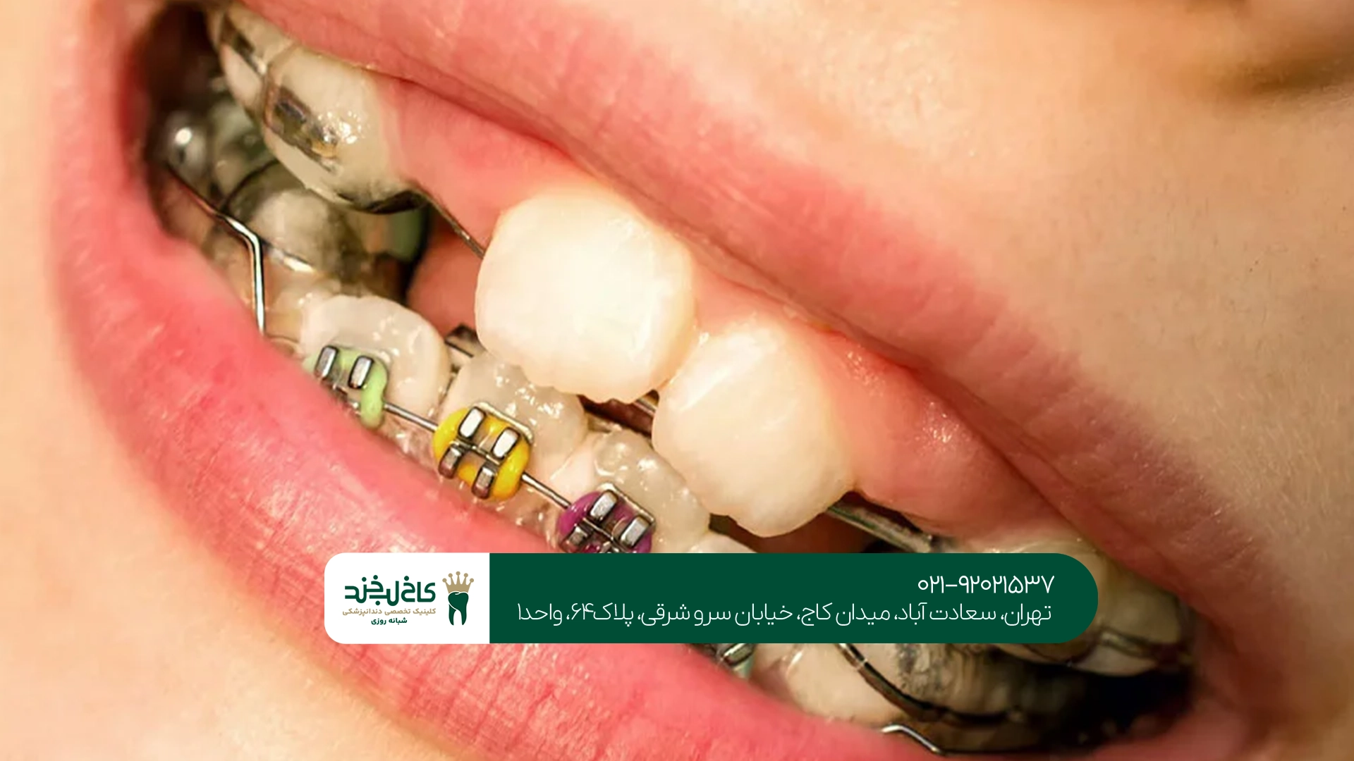 ارتودنسی حرفه ای در کلینیک دندانپزشکی ارتودنسی حرفه ای در کلینیک دندانپزشکی