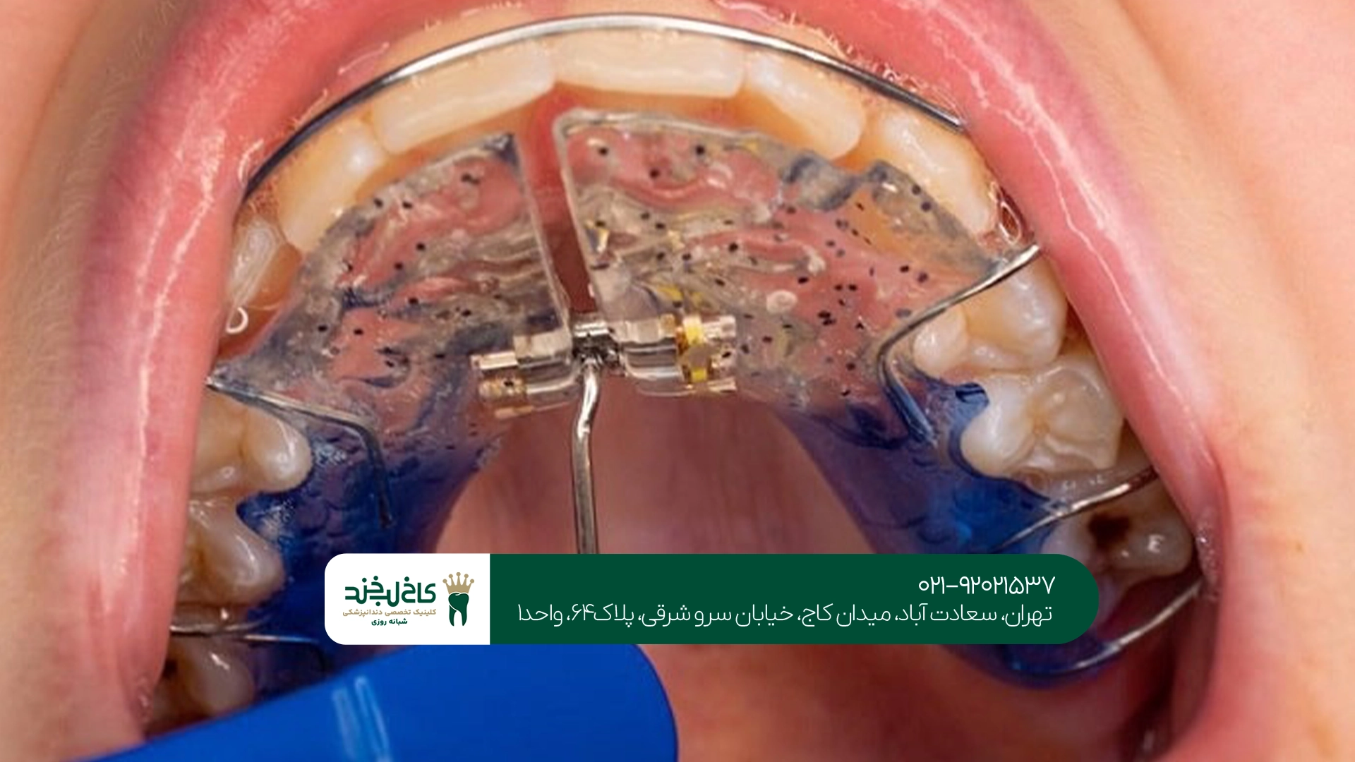 مزایای کشیدن دندان در درمان ارتودنسی مزایای کشیدن دندان در درمان ارتودنسی