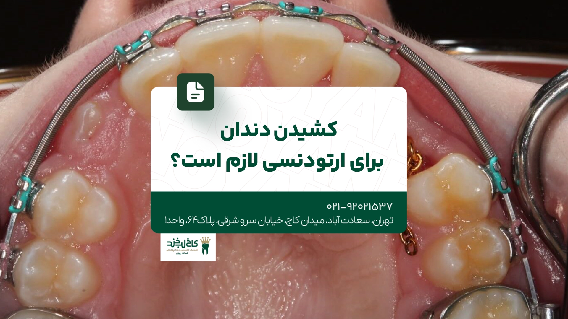 کشیدن دندان برای ارتودنسی لازم است؟ کشیدن دندان برای ارتودنسی لازم است؟