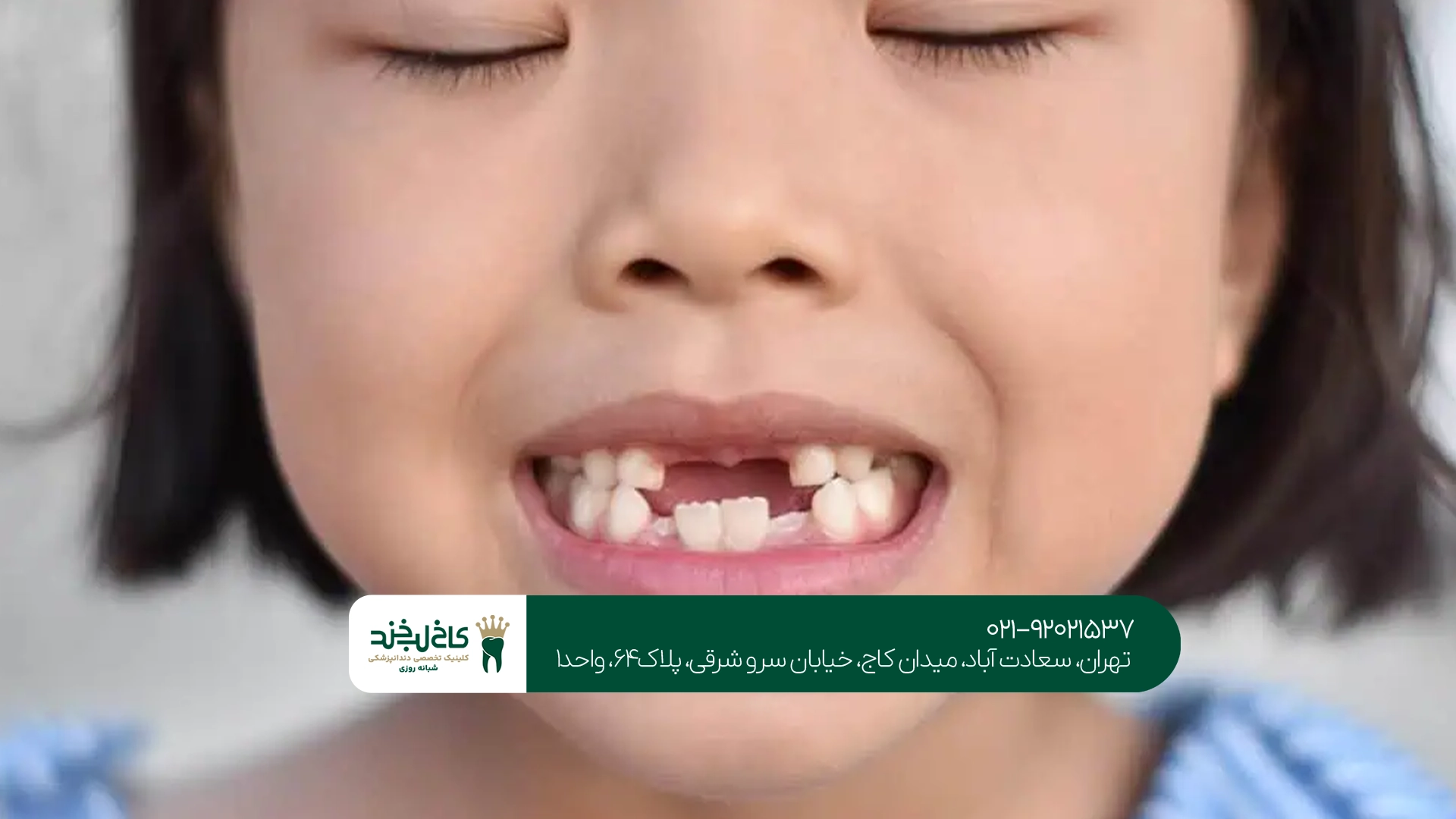 کشیدن دندان شیری در تهران کشیدن دندان شیری در تهران
