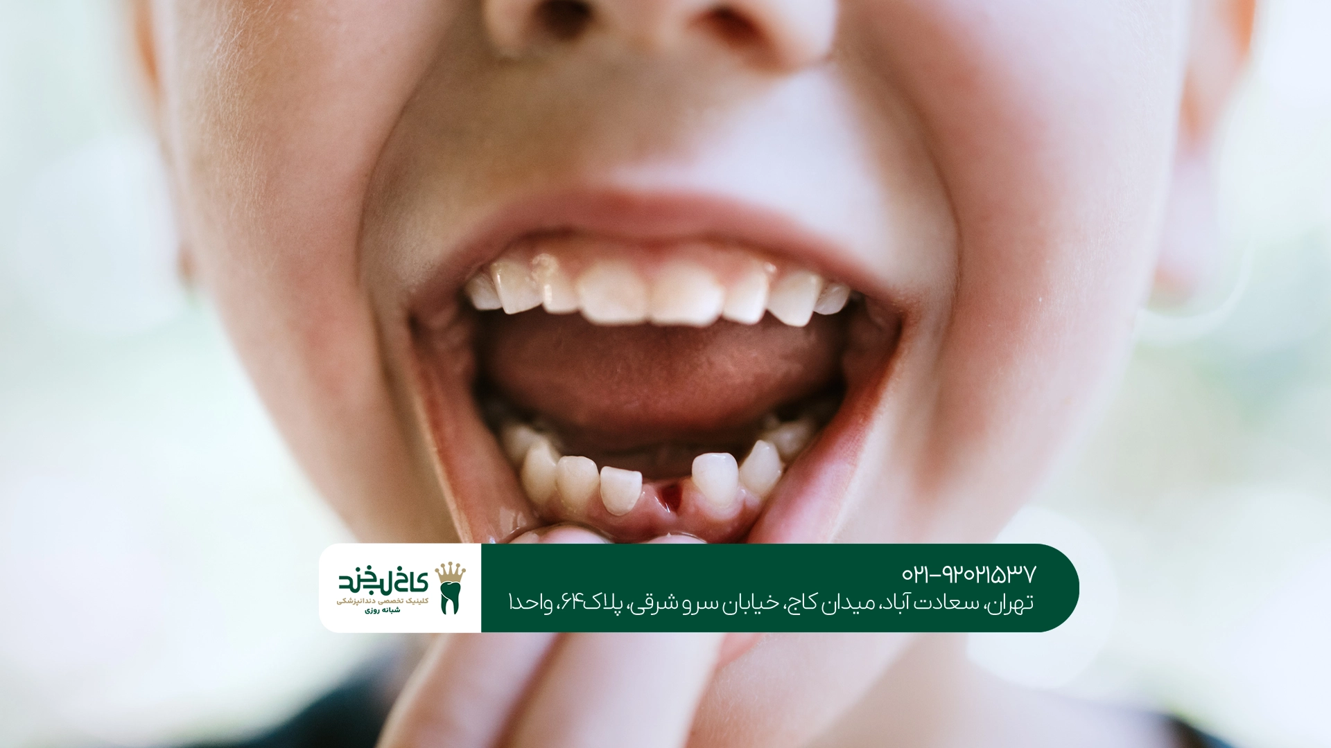 دندانپزشکی اطفال در تهران دندانپزشکی اطفال در تهران