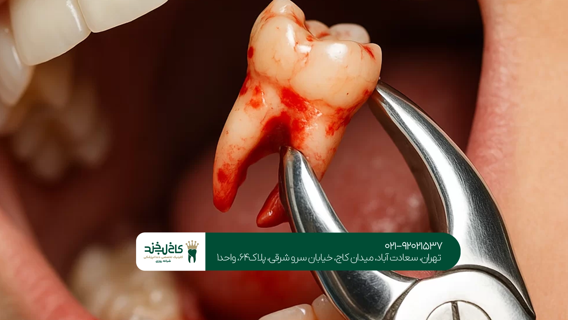 بهترین زمان برای کشیدن دندان عقل بهترین زمان برای کشیدن دندان عقل