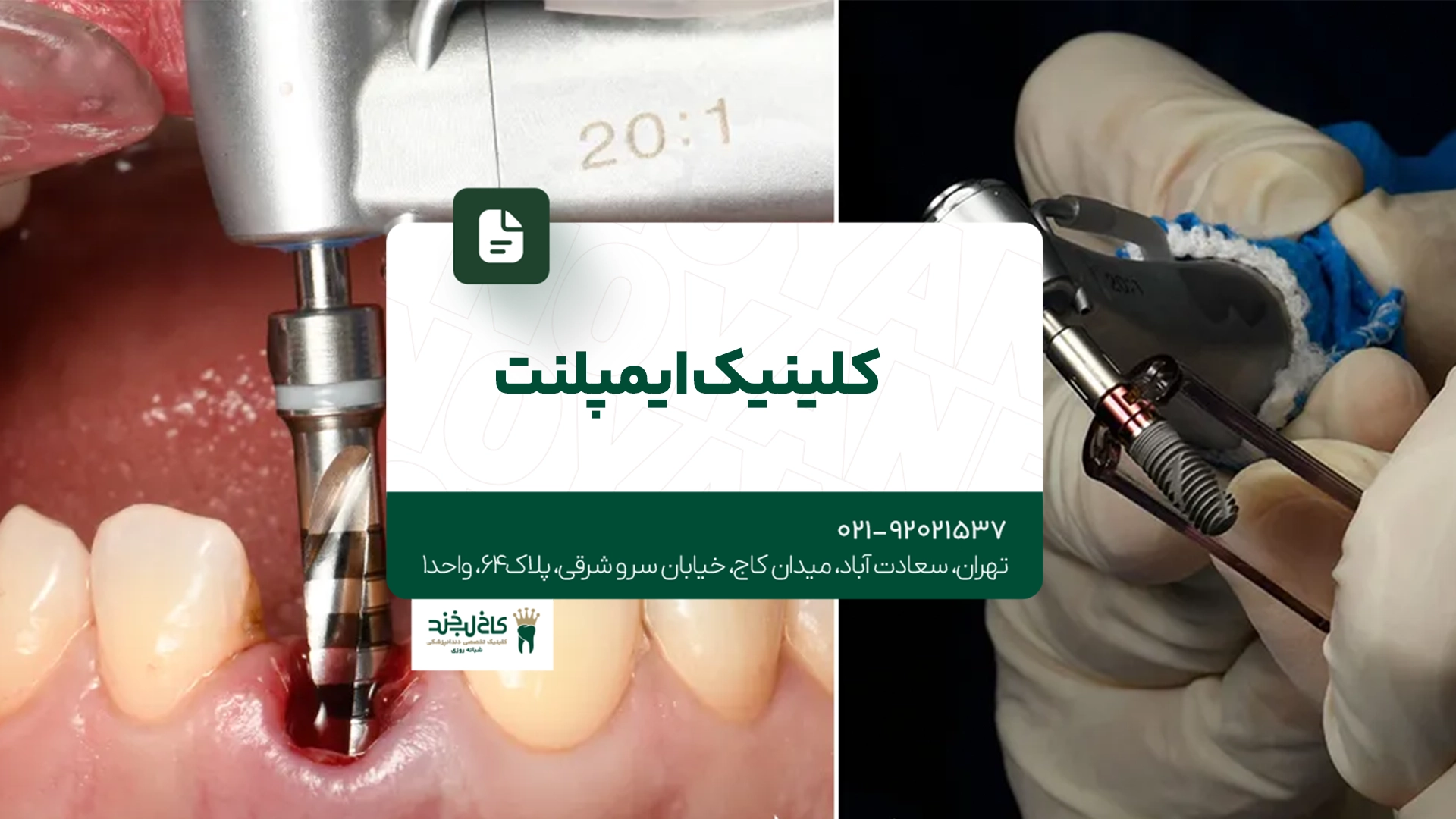 کلینیک ایمپلنت
