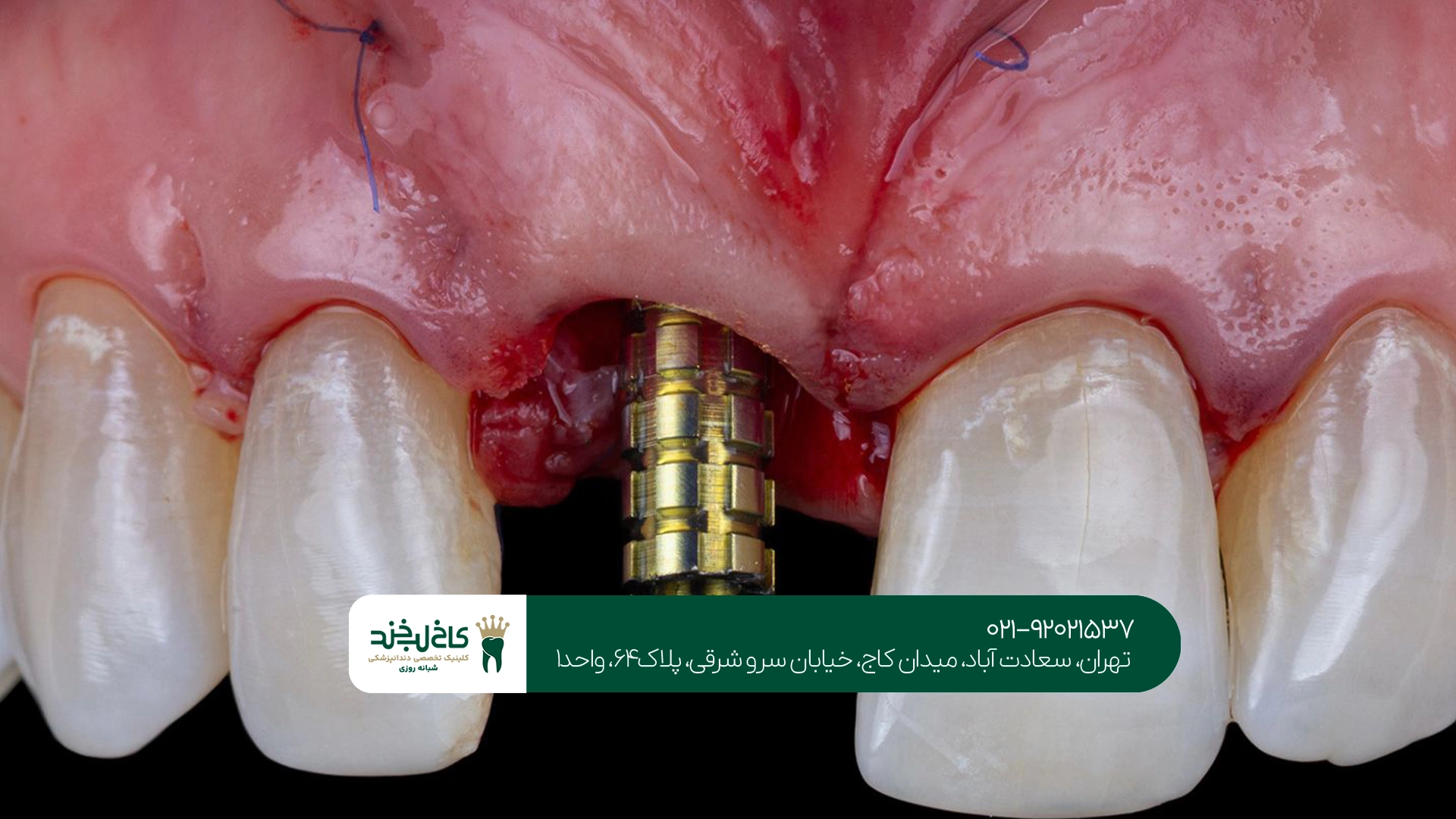بهترین زمان برای درمانهای دندانپزشکی در بارداری