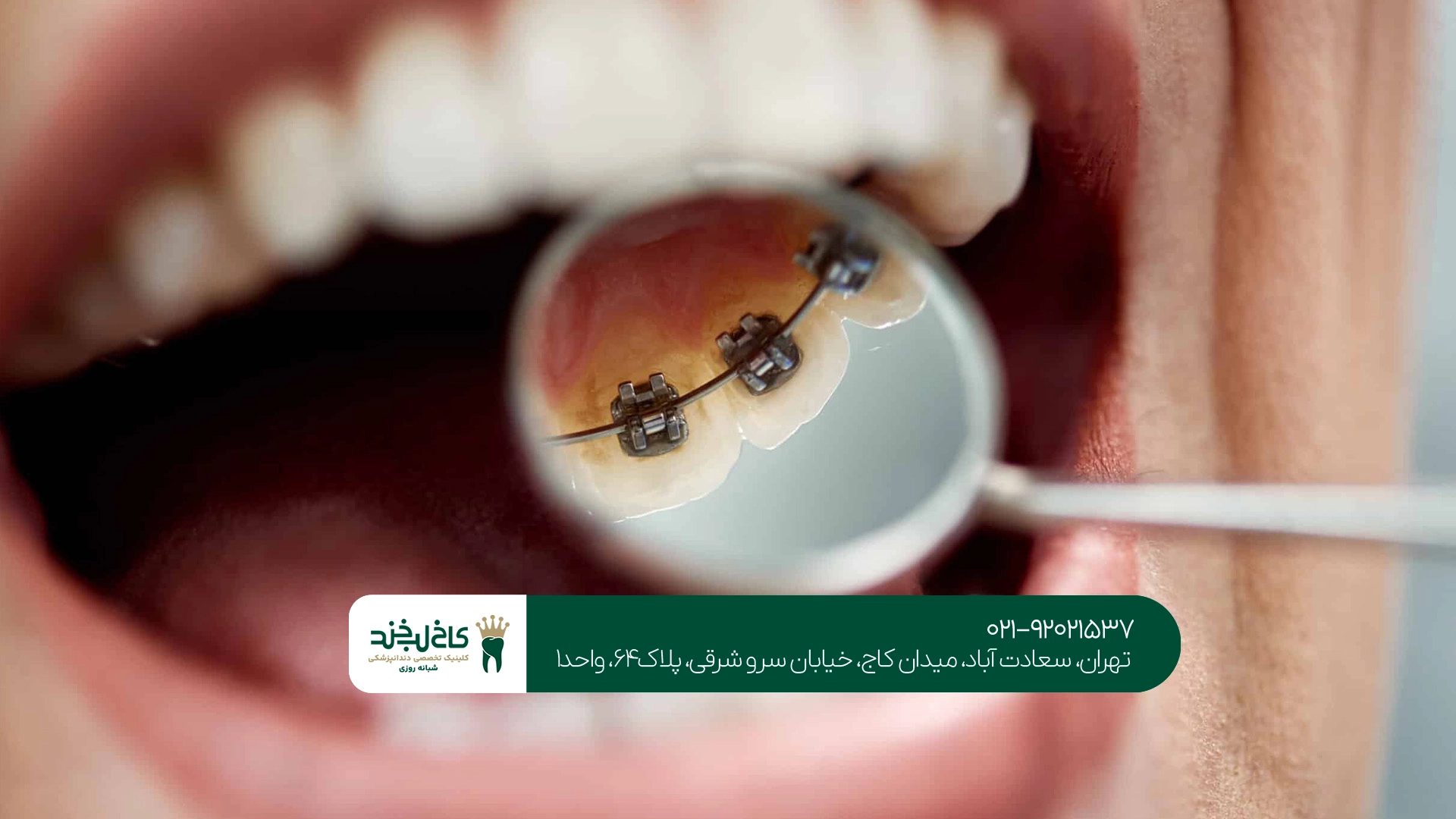 آیا ارتودنسی در بزرگسالی امکانپذیر است؟