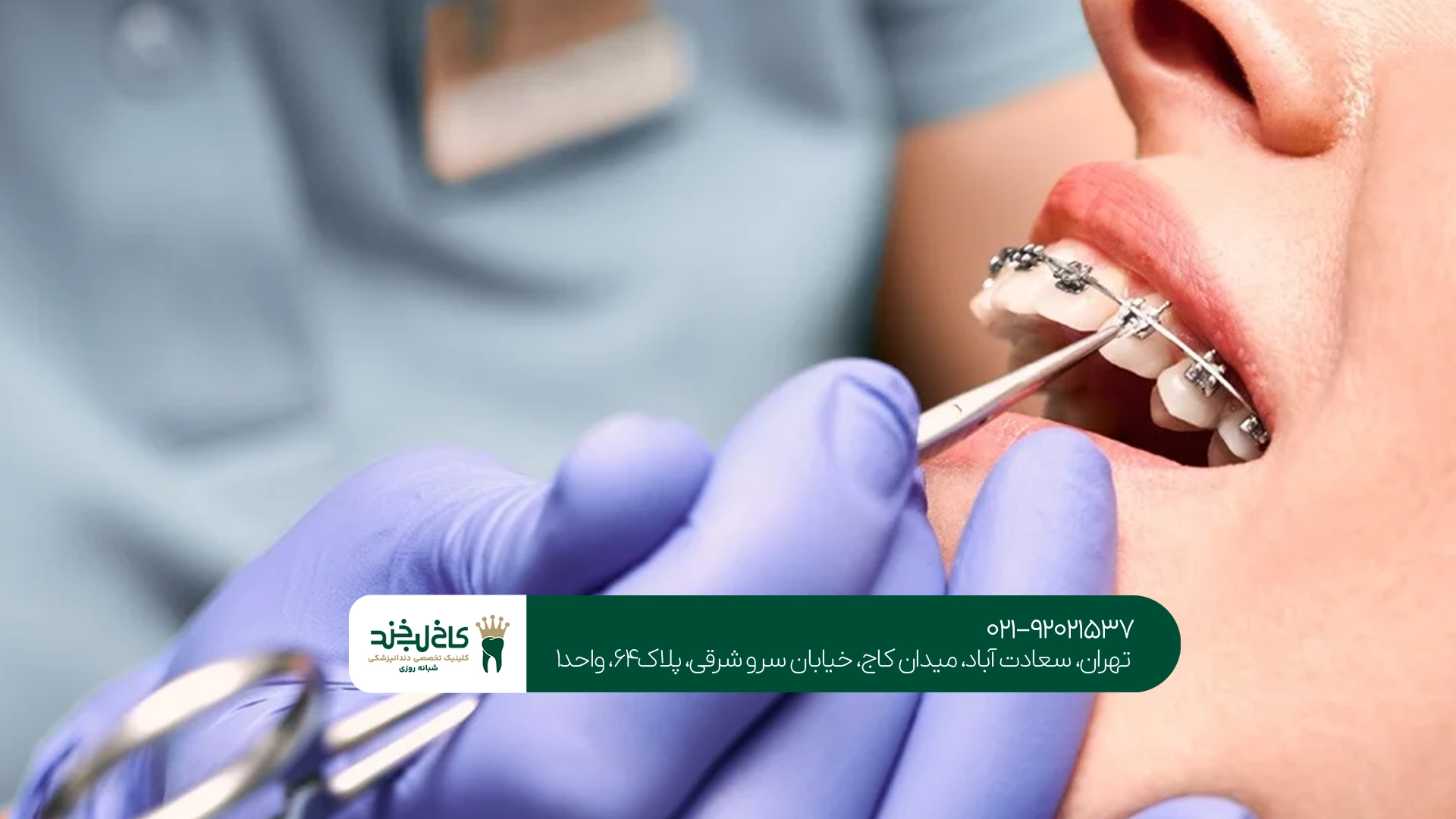 شرایط دریافت ارتودنسی دندان اقساطی چیست؟