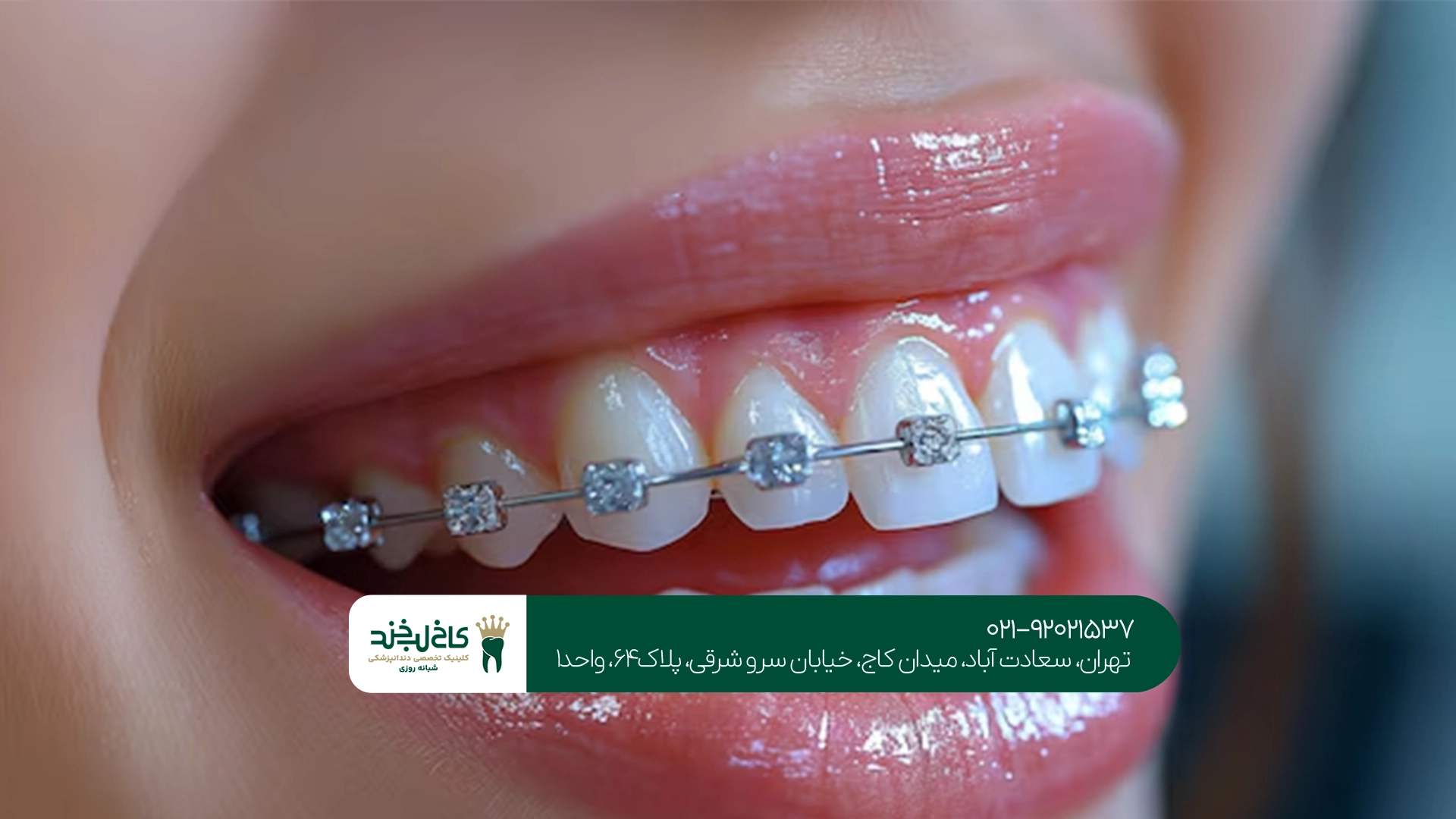 چه افرادی میتوانند از ارتودنسی دندان اقساطی استفاده کنند؟