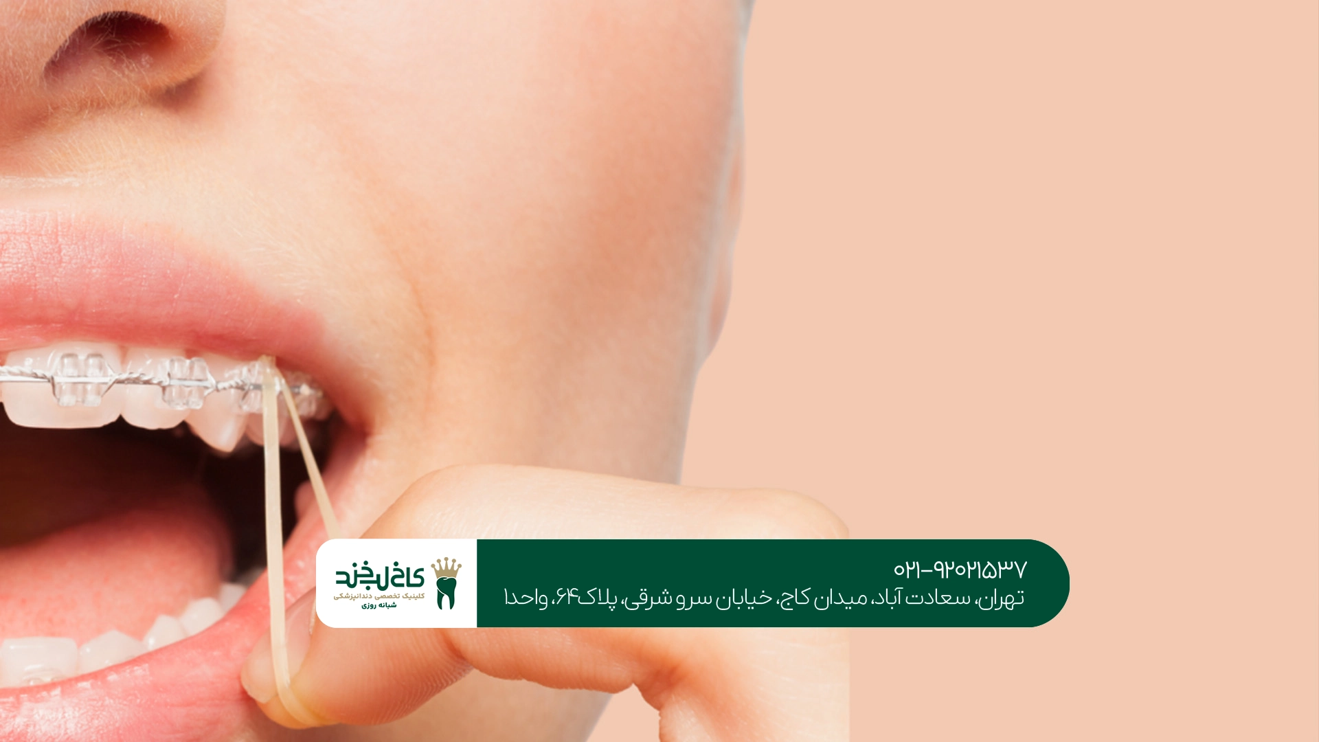 ارتودنسی دندان جلو تهران ارتودنسی دندان جلو تهران