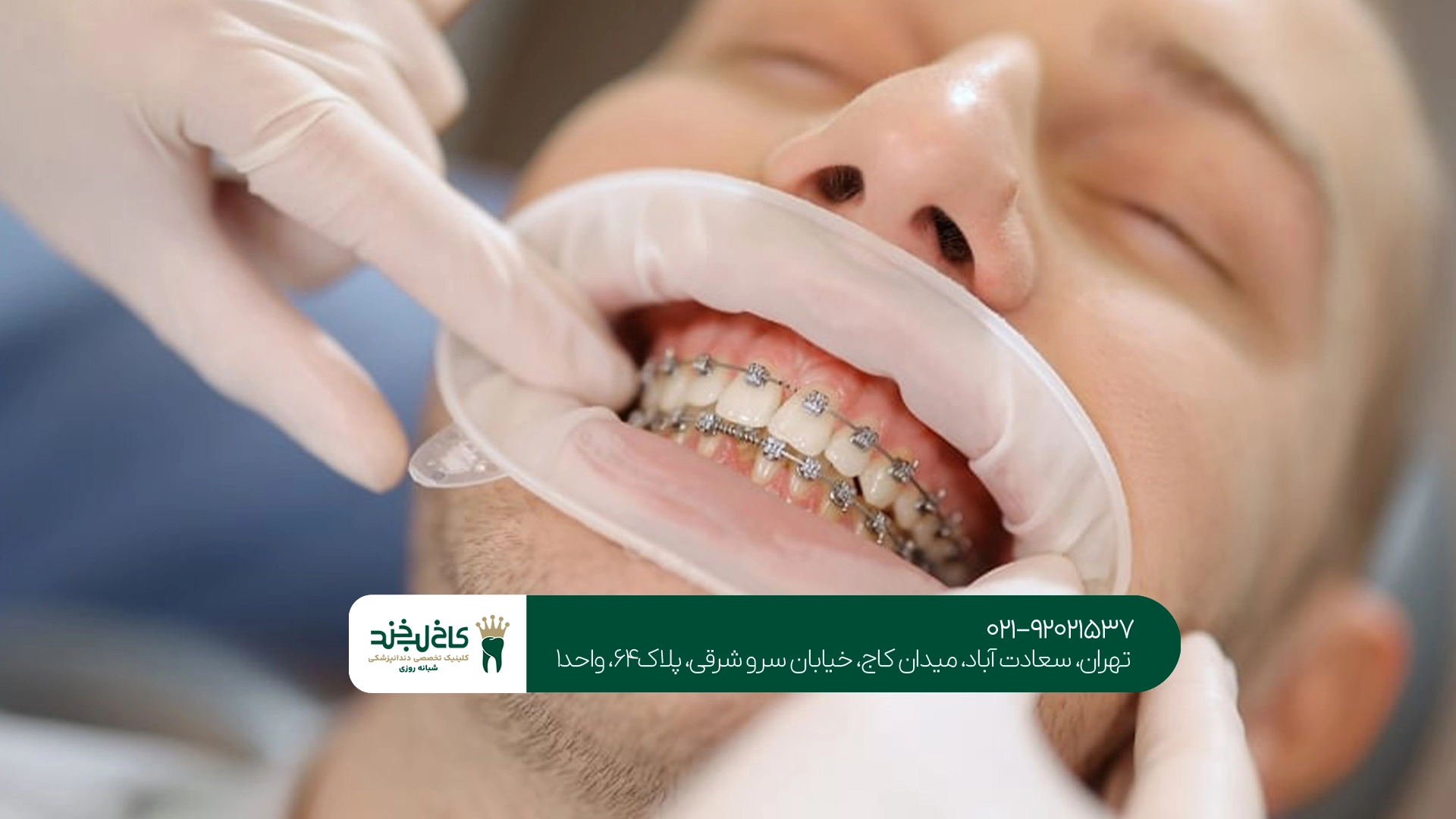 مراحل درمان ارتودنسی دندان جلو مراحل درمان ارتودنسی دندان جلو