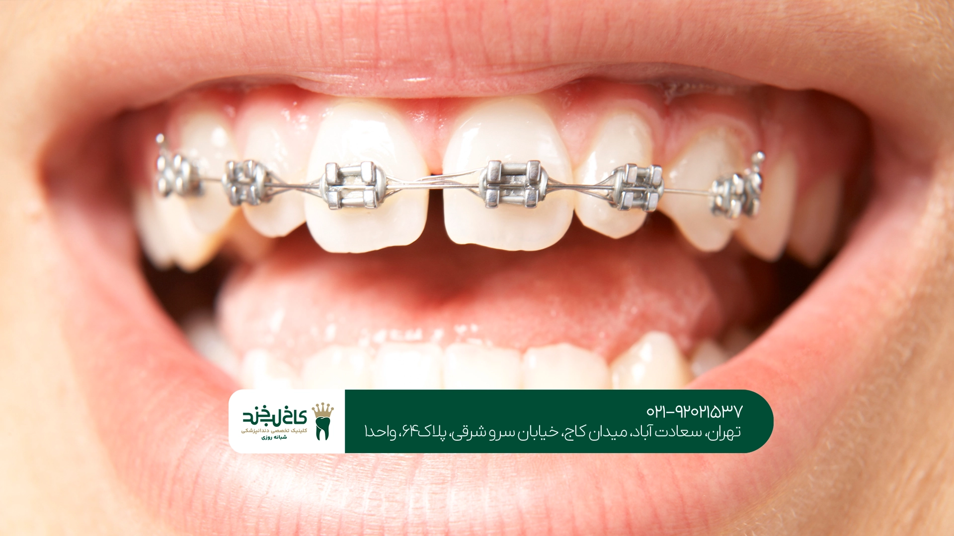 ارتودنسی دندان در تهران ارتودنسی دندان در تهران