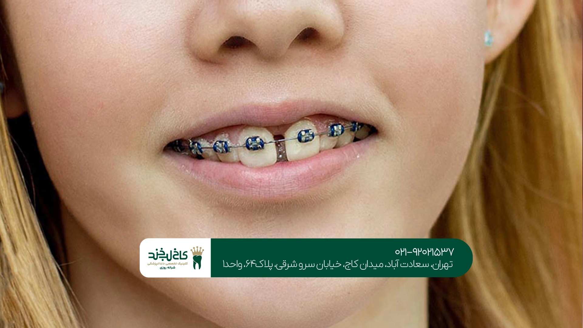 ارتودنسی دندان فاصله دار در تهران ارتودنسی دندان فاصله دار در تهران