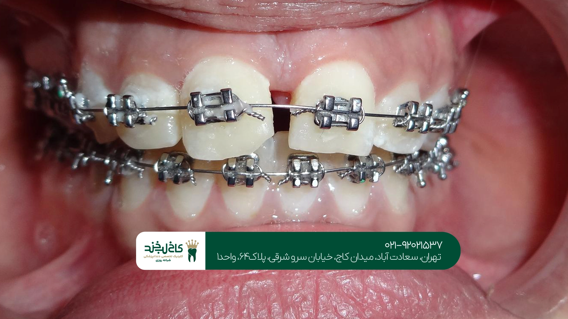 ارتودنسی نامرئی برای دندان فاصله دار ارتودنسی نامرئی برای دندان فاصله دار