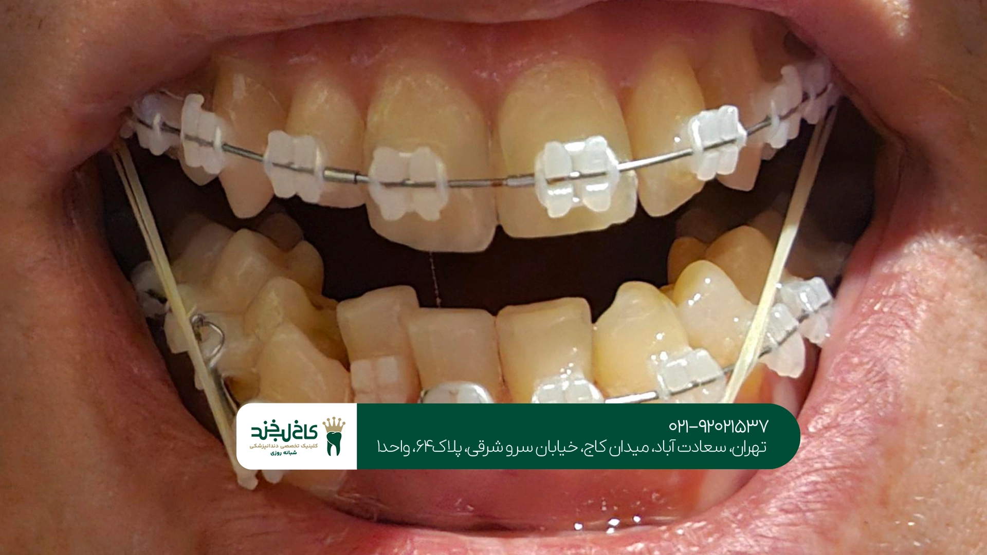 مشاوره تخصصی ارتودنسی دندان نامرتب مشاوره تخصصی ارتودنسی دندان نامرتب