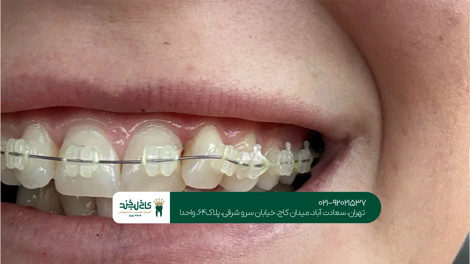 ارتودنسی دندان در تهران ارتودنسی دندان در تهران