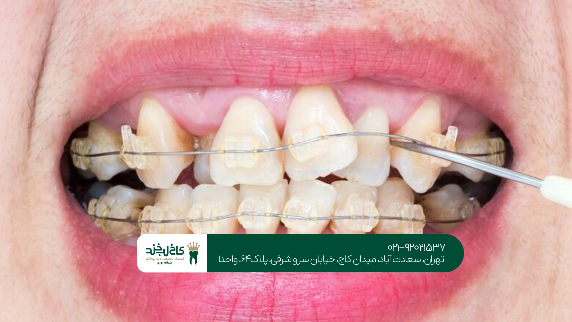 ارتودنسی دندان ارتودنسی دندان