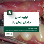 ارتودنسی دندان نیش بالا