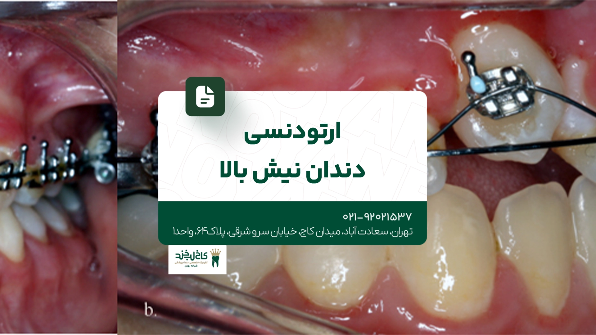 ارتودنسی دندان نیش بالا