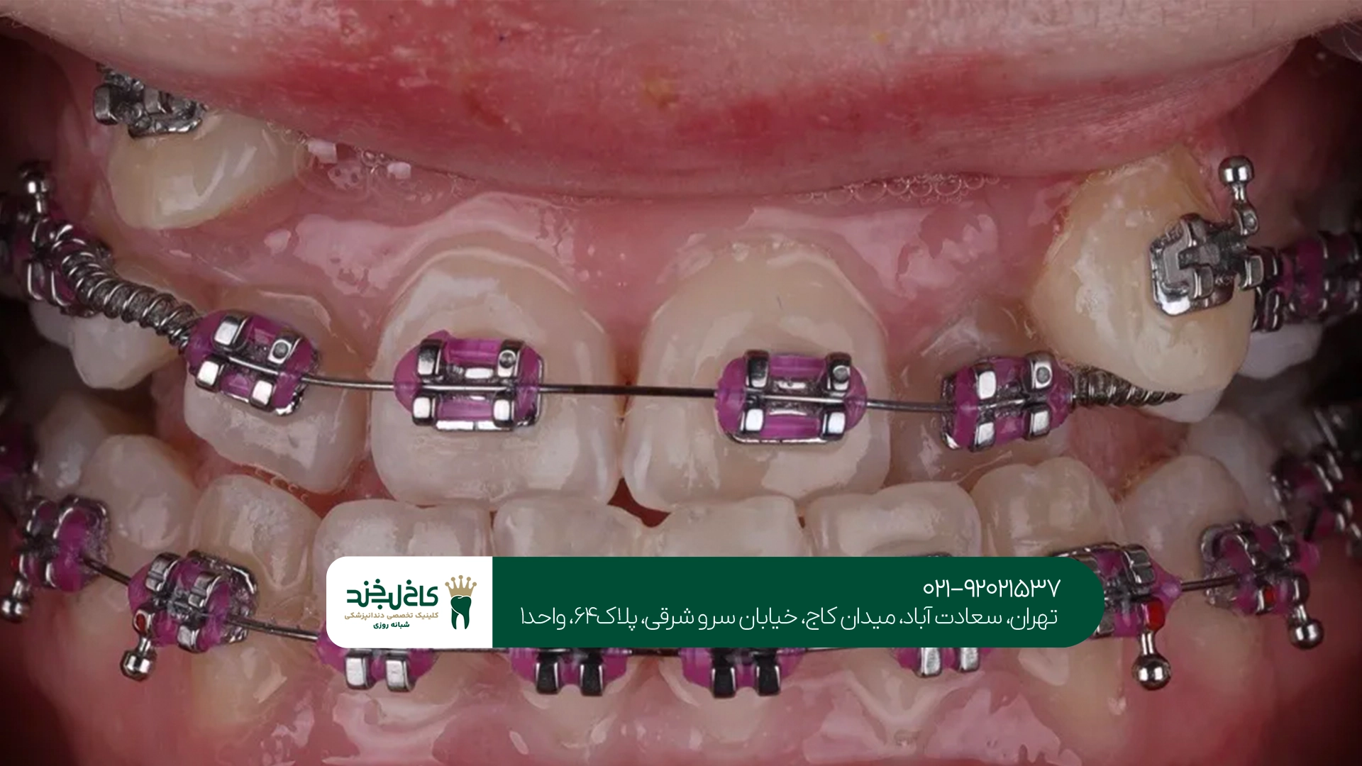 متخصص ارتودنسی دندان نیش