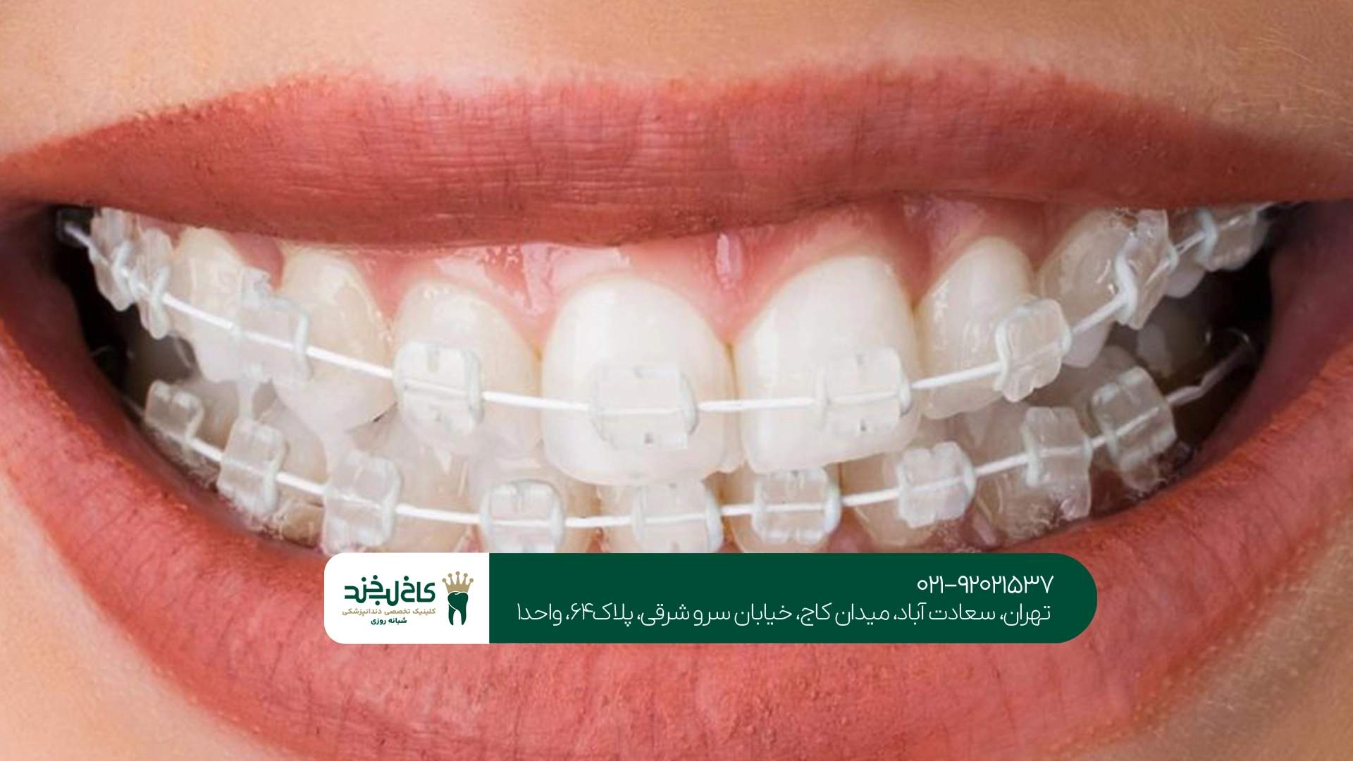 بهترین کلینیک ارتودنسی سرامیکی بهترین کلینیک ارتودنسی سرامیکی
