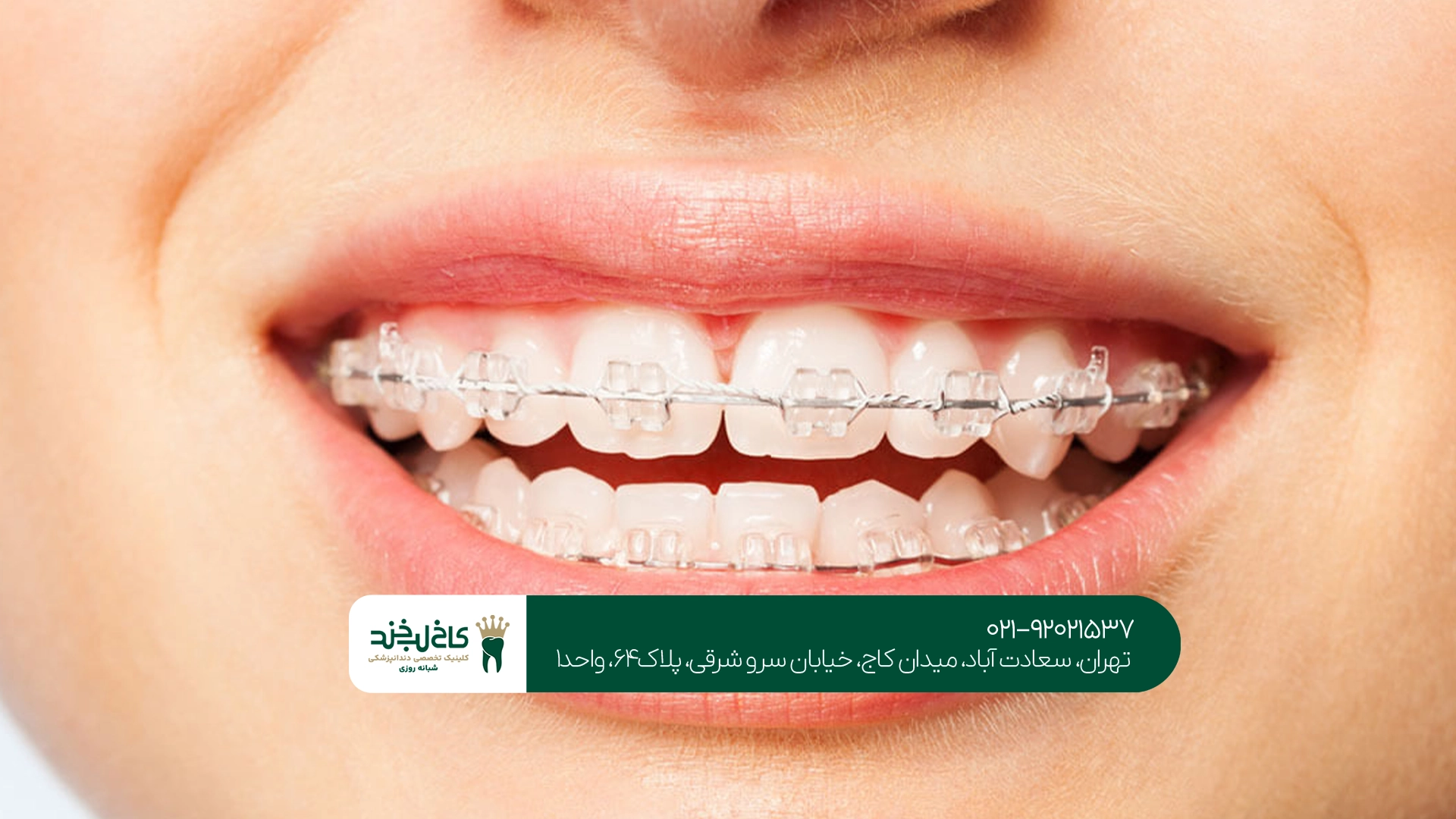 ارتودنسی سرامیکی ارتودنسی سرامیکی