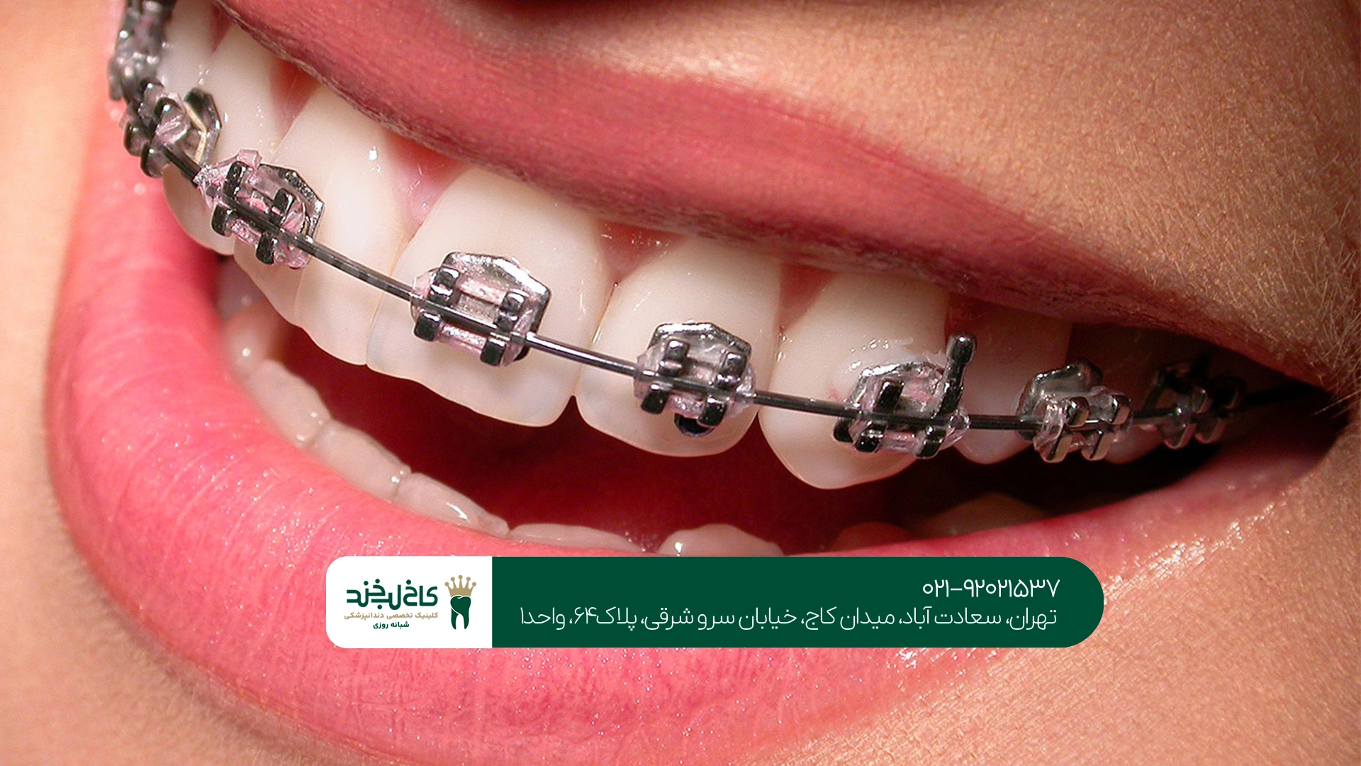 هزینه ارتودنسی فک بالا