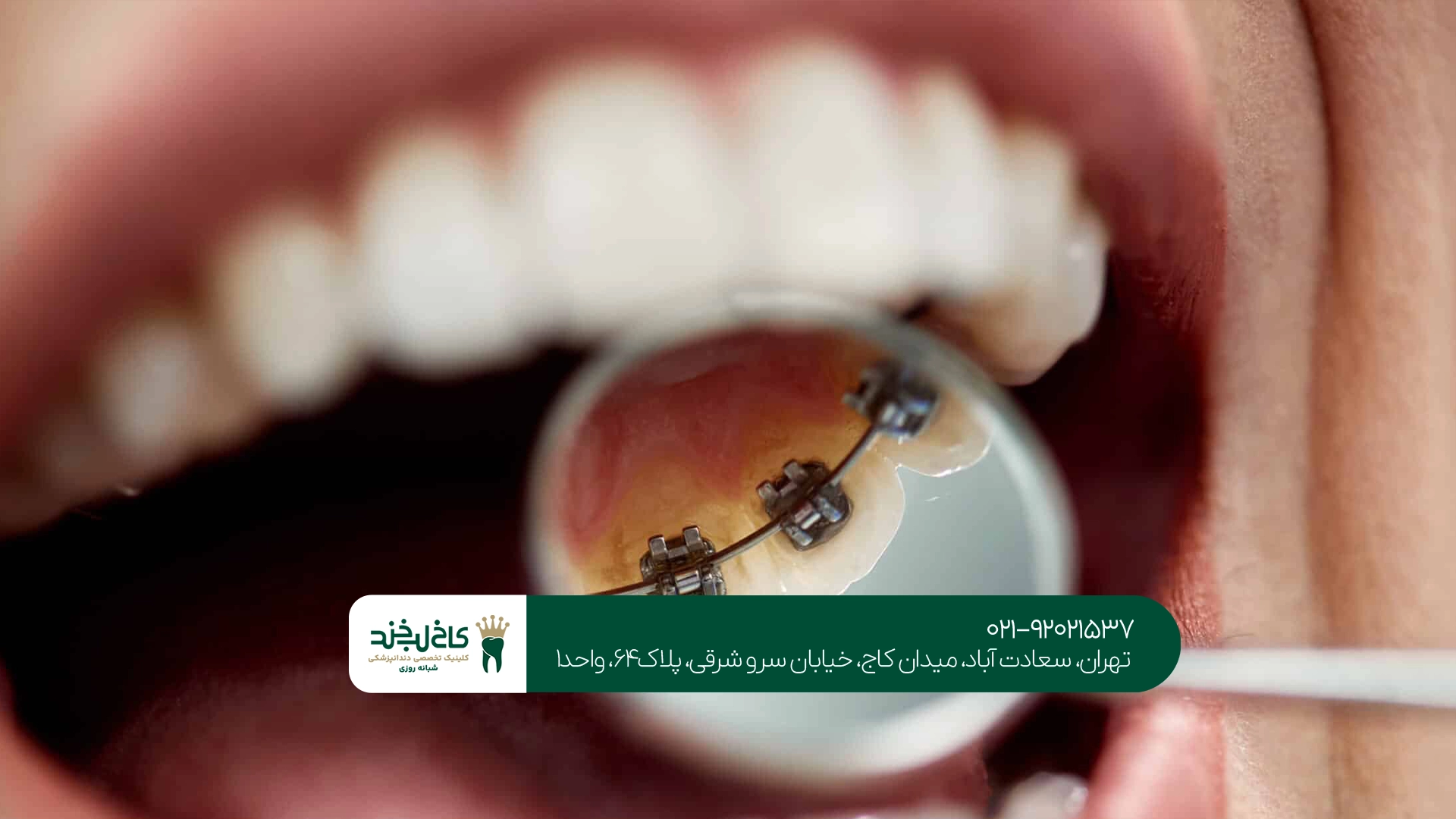 بهترین مرکز ارتودنسی کوتاه مدت