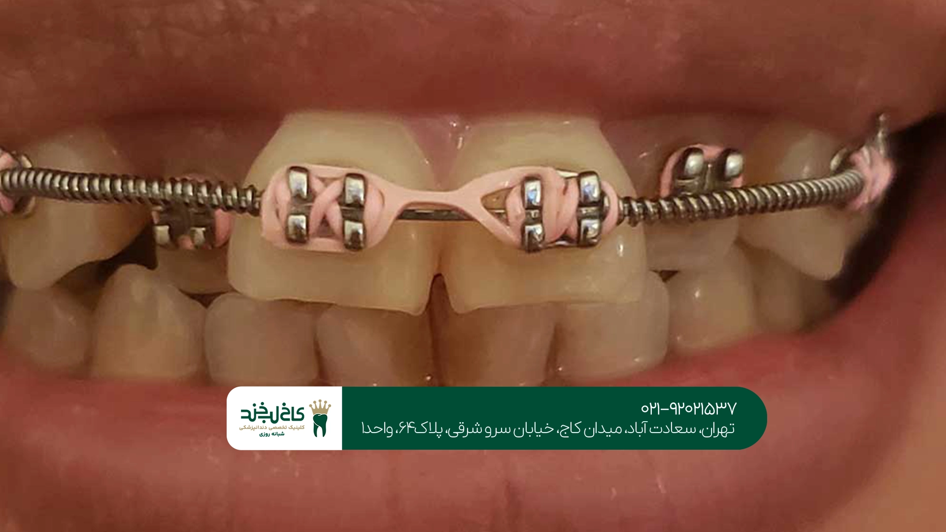 مدت زمان ارتودنسی کوتاه مدت