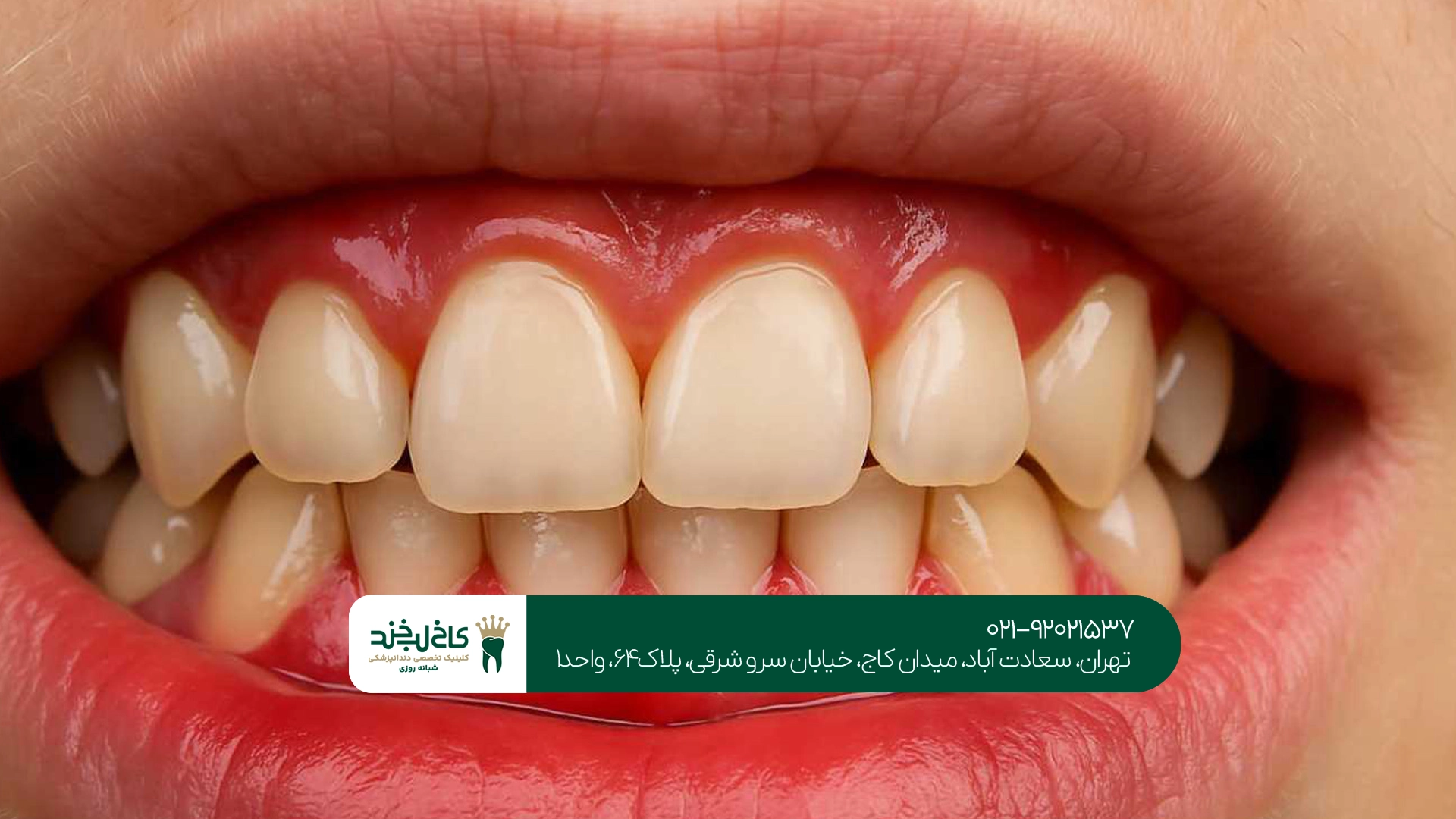 روشهای مختلف اصلاح طرح لبخند روشهای مختلف اصلاح طرح لبخند