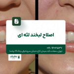 اصلاح لبخند لثهای